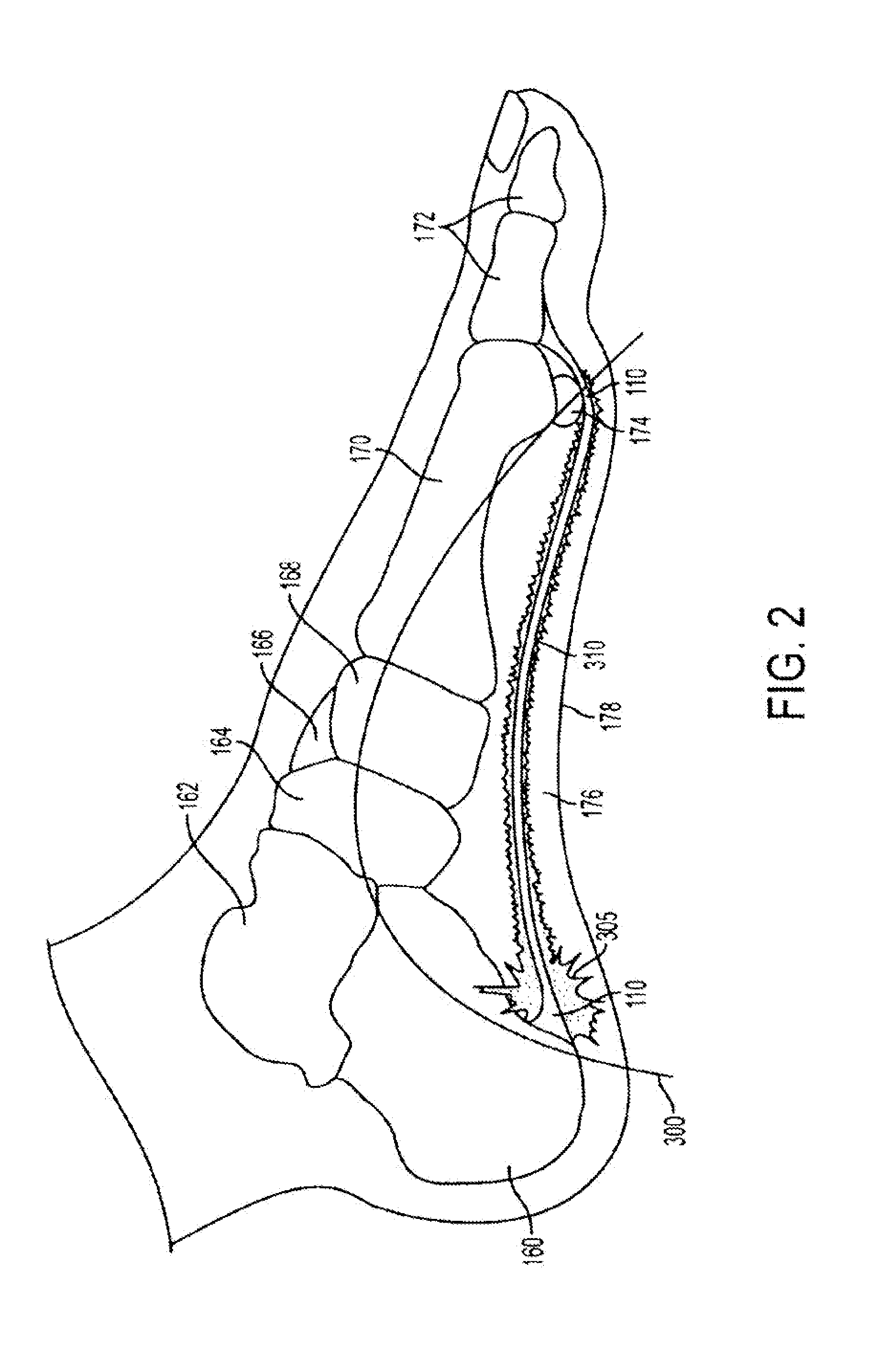 System of Treatment for Plantar Fasciitis