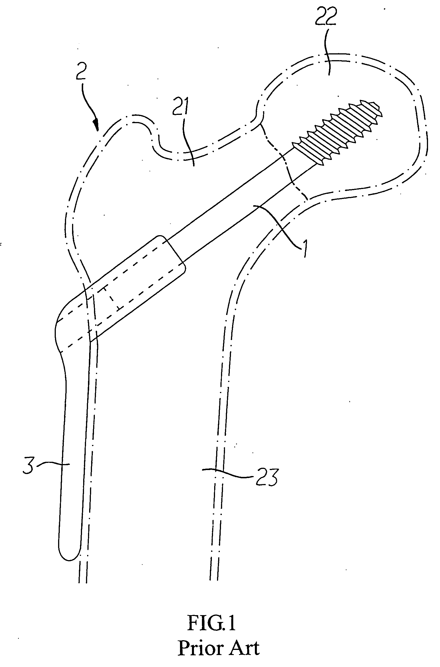 Interlocking hip screw