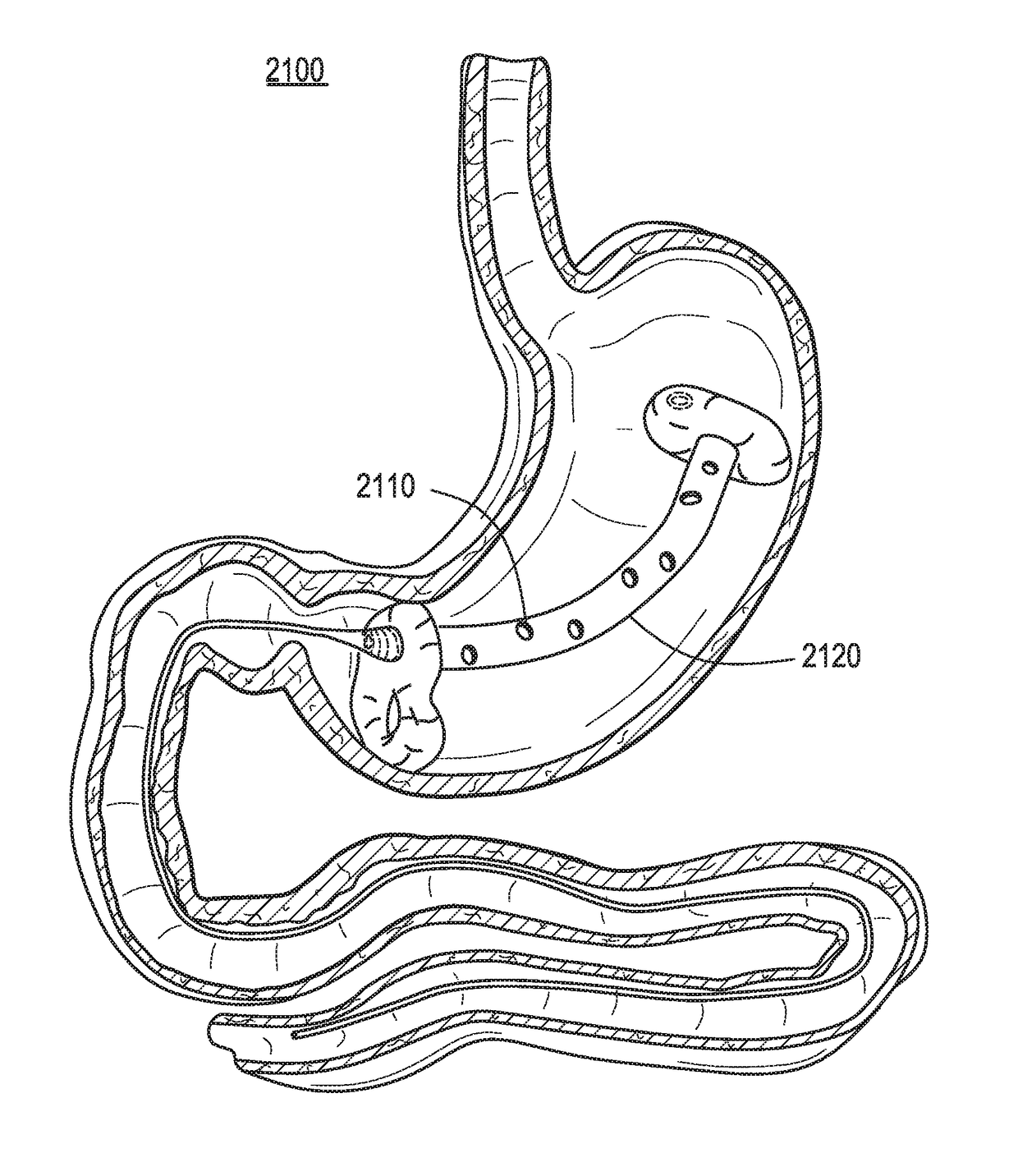 Passive Caloric Bypass Device