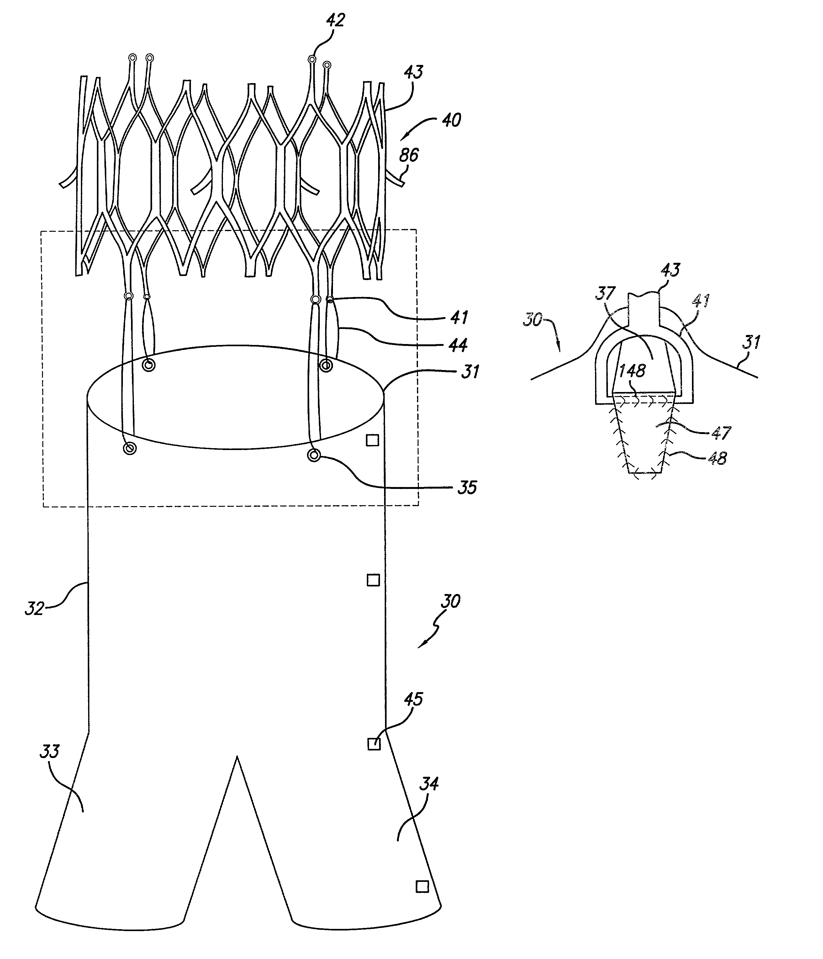 Endovascular graft device and methods for attaching components thereof