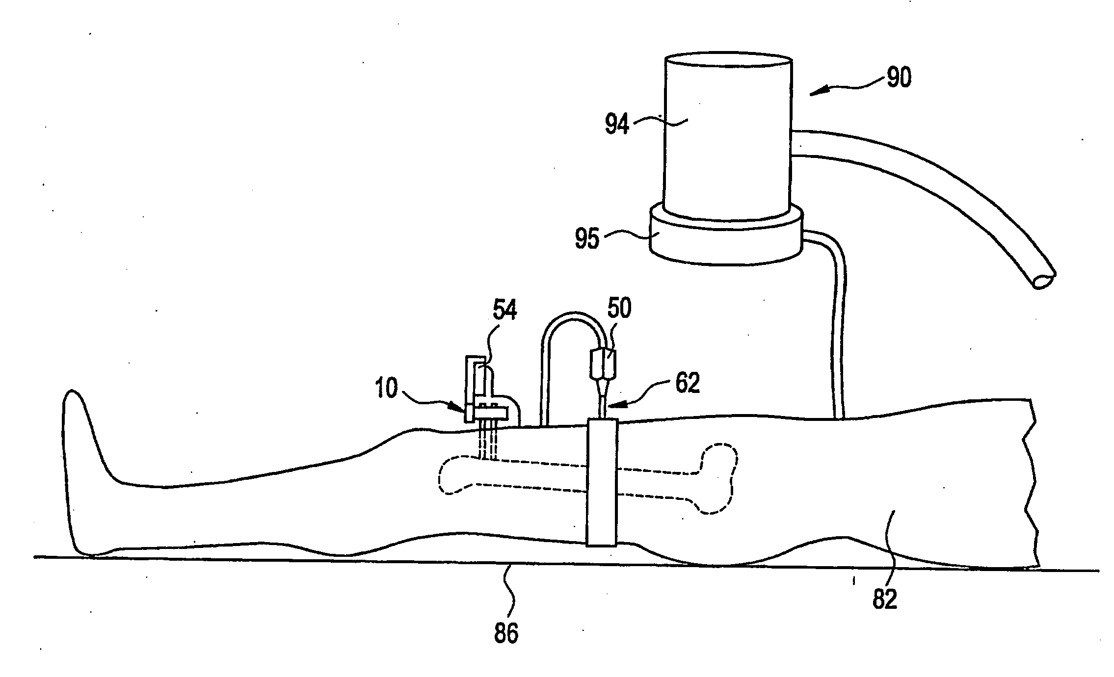 Interchangeable localizing devices for use with tracking systems