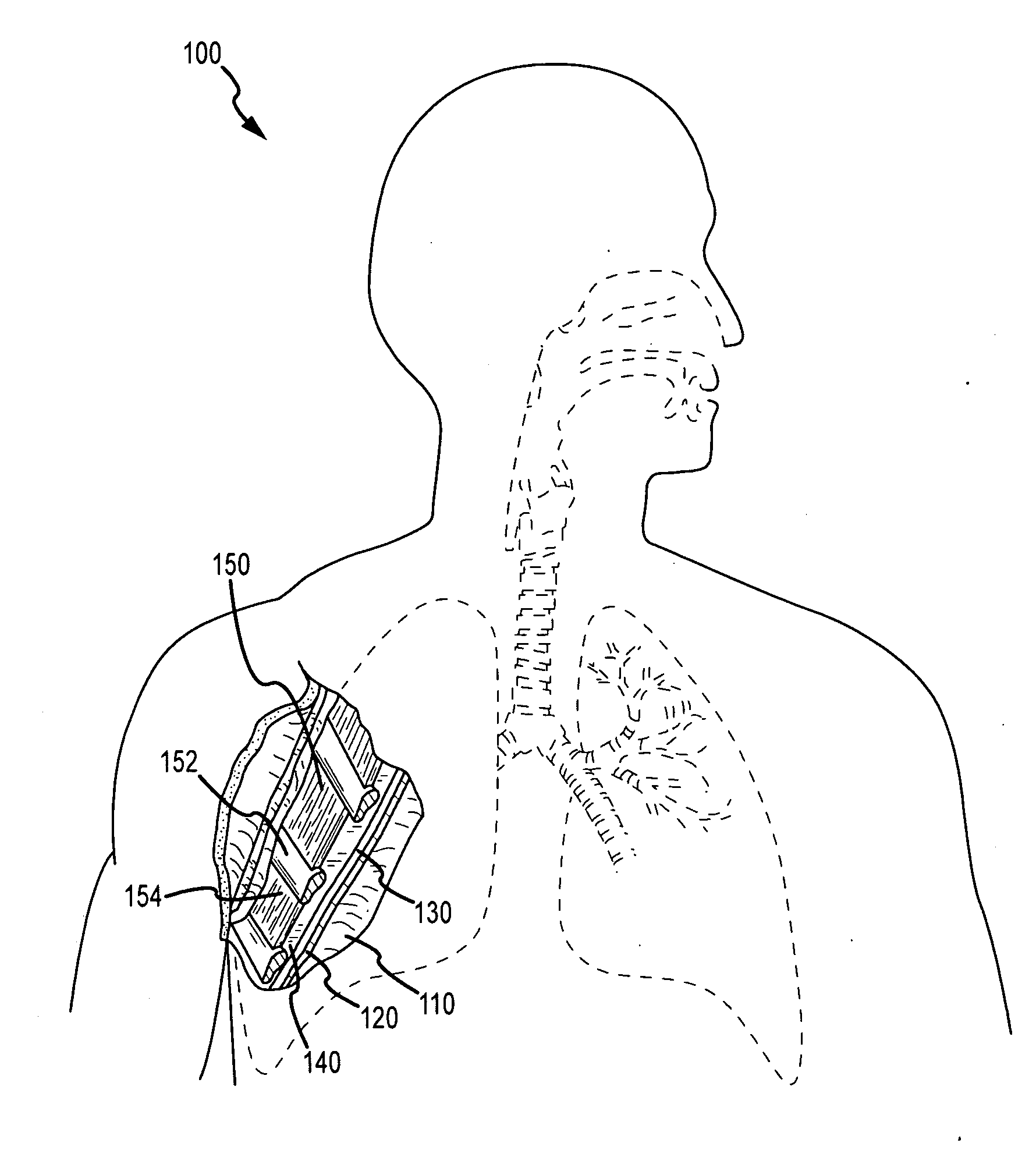 Use of a regenerative biofunctional collagen biomatrix for treating visceral or parietal defects