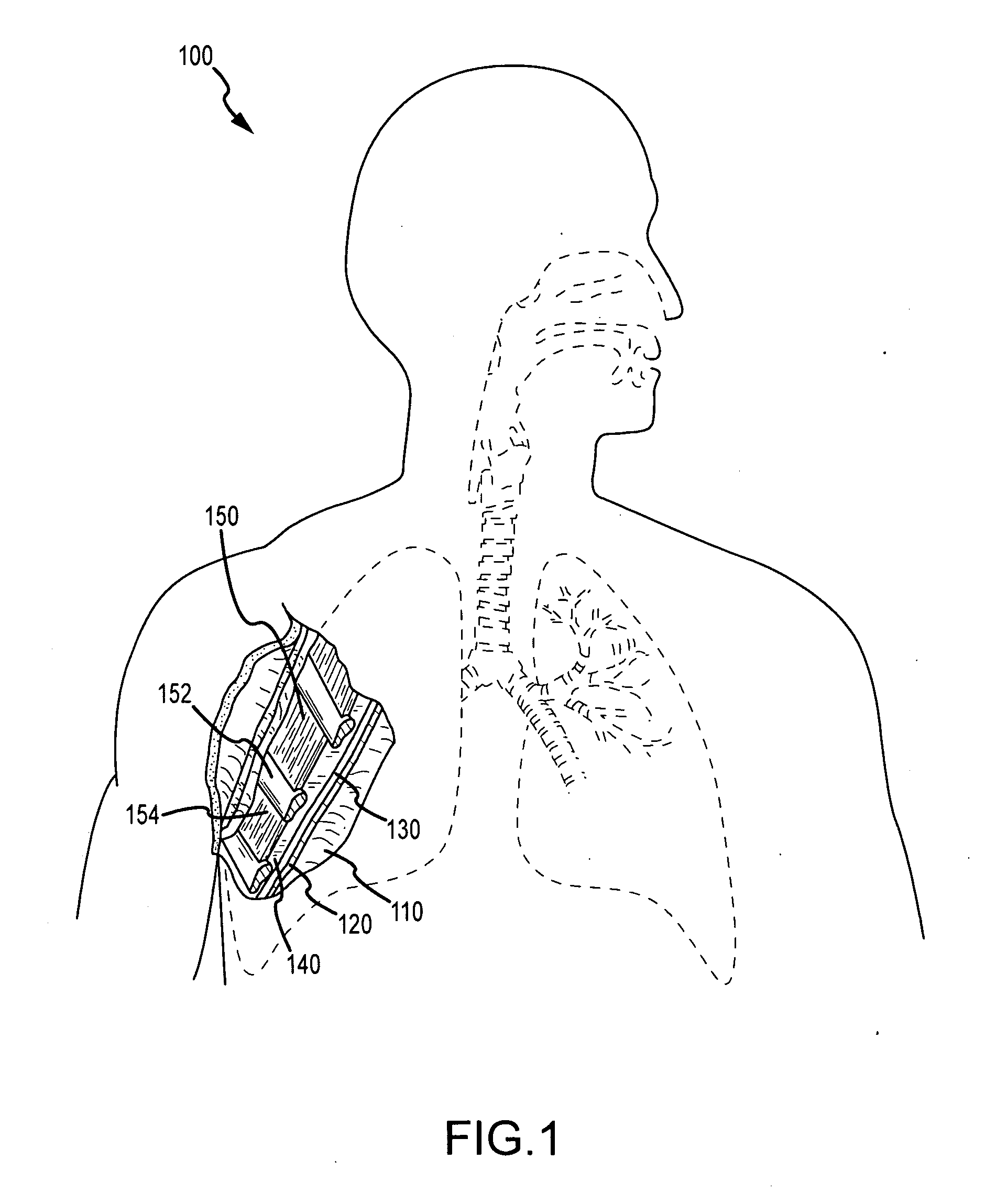 Use of a regenerative biofunctional collagen biomatrix for treating visceral or parietal defects