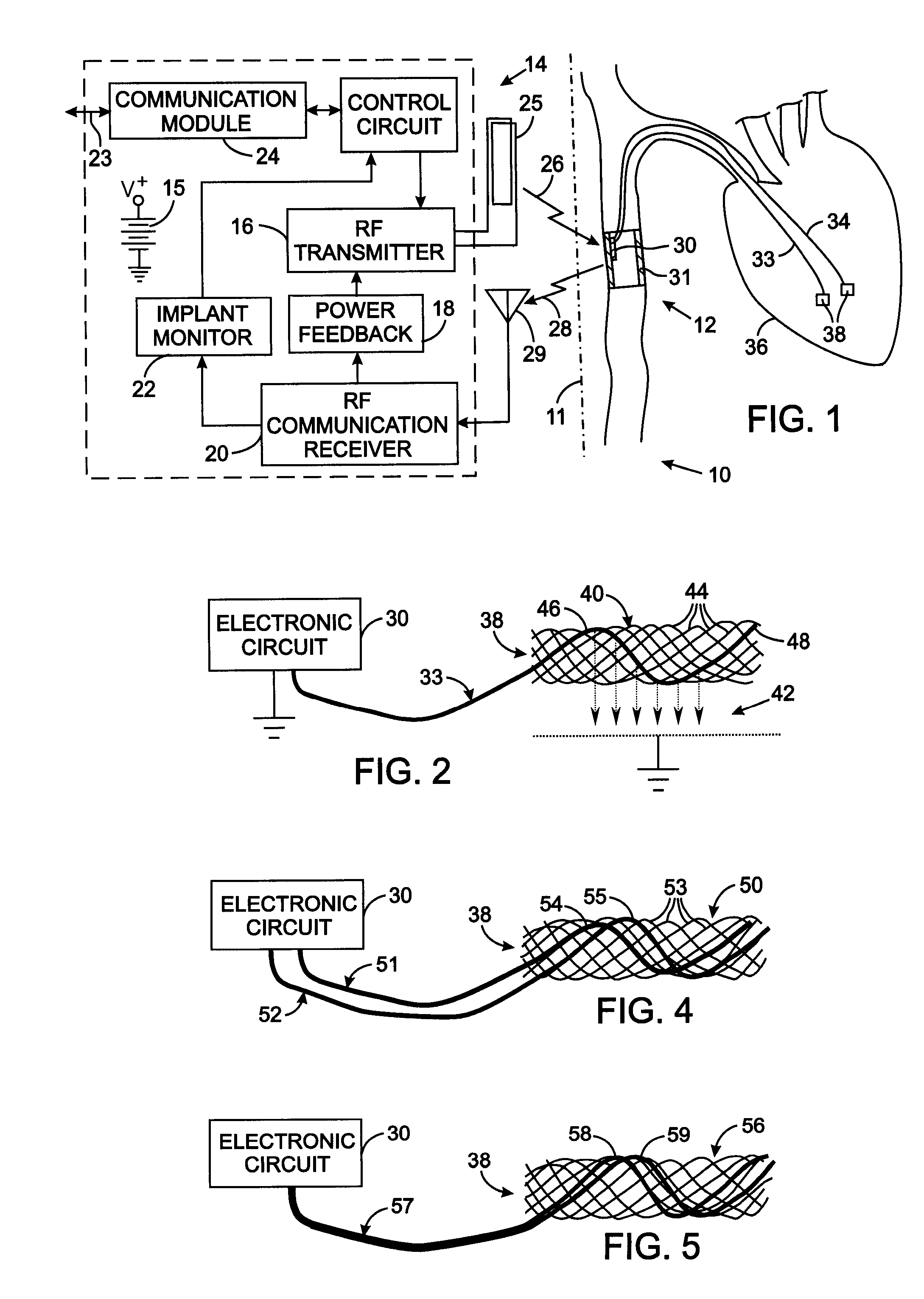 Intravascular Electronics Carrier Electrode for a Transvascular Tissue Stimulation System