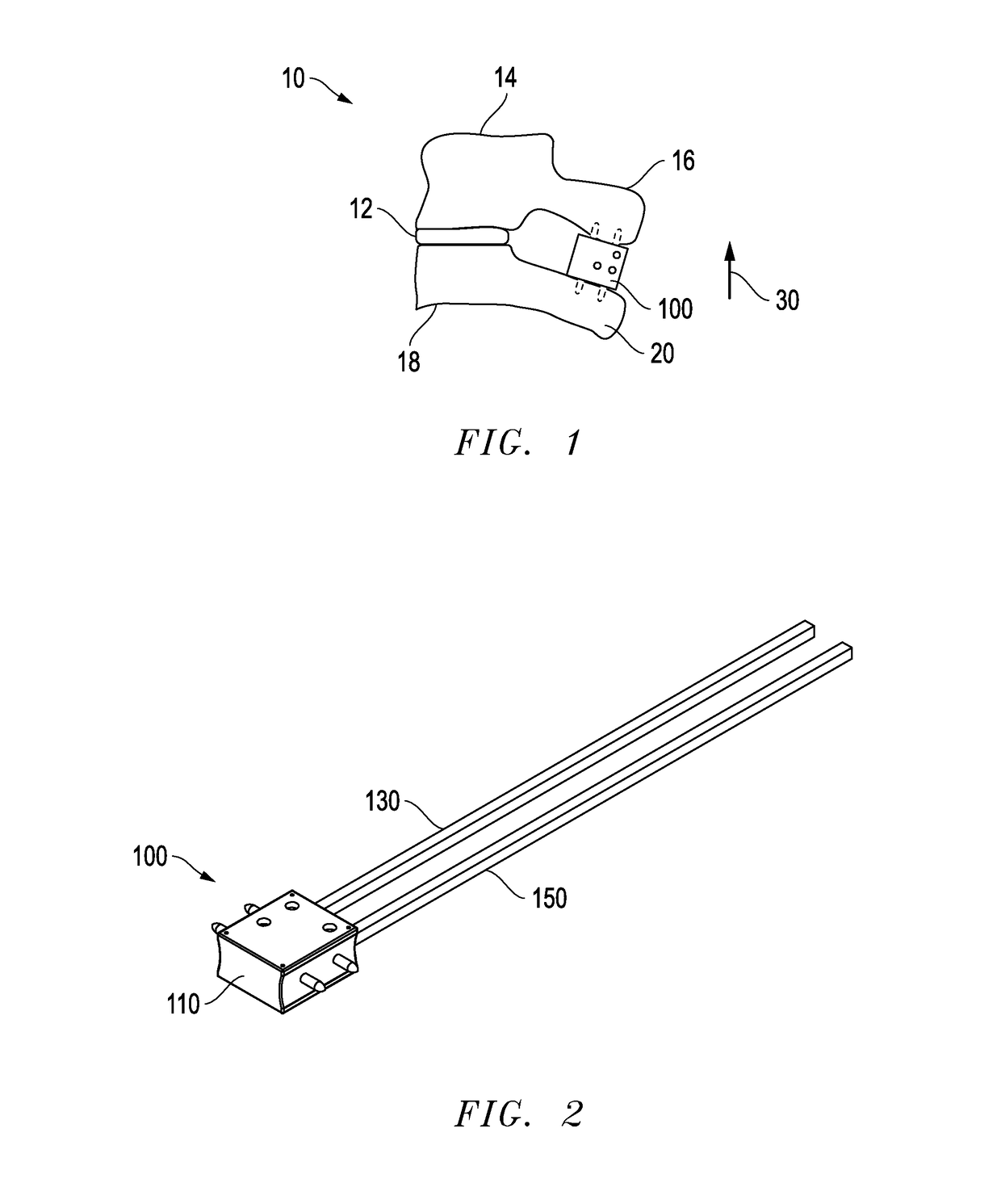 Interlaminar fixation device