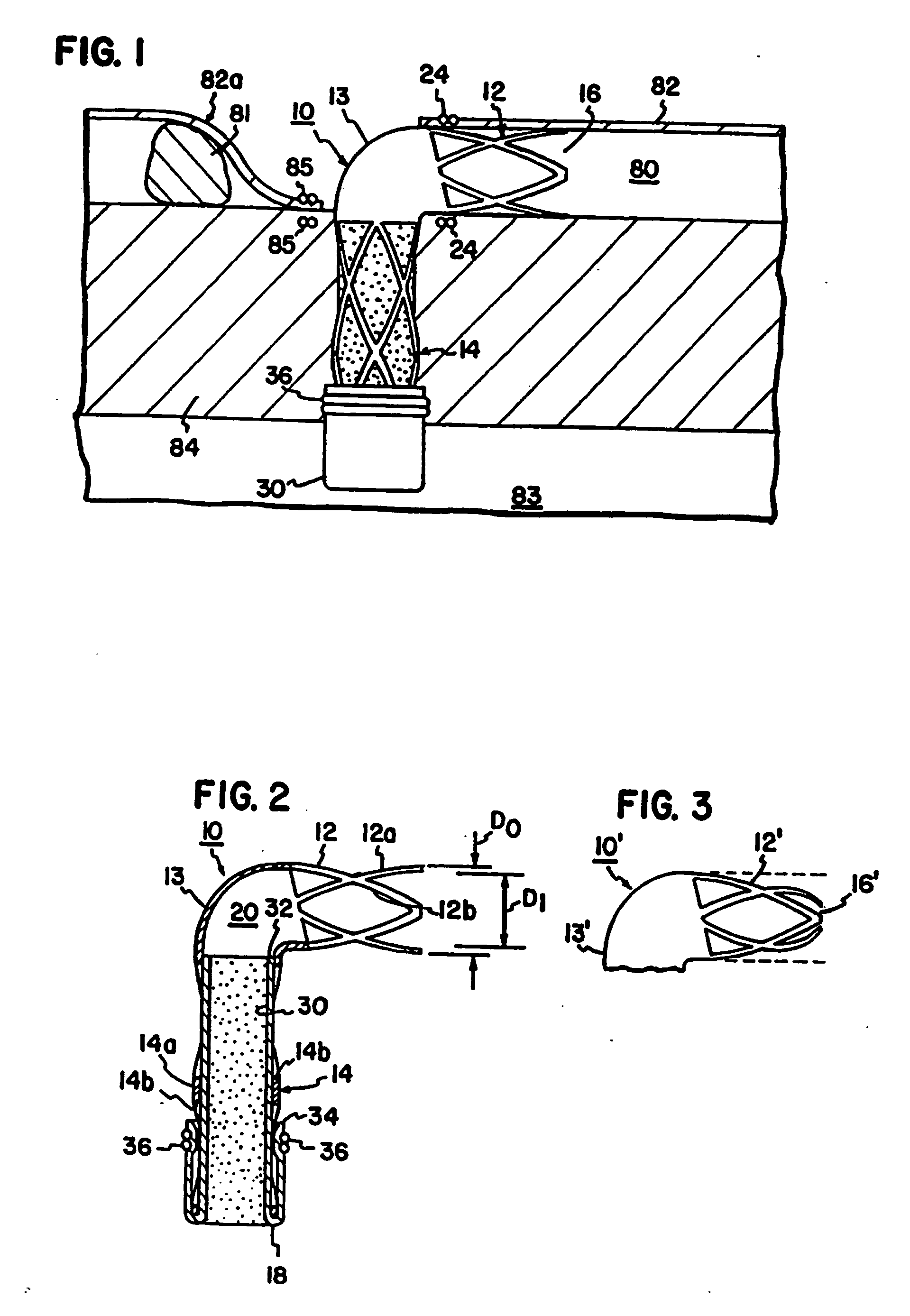 Healing transmyocardial implant