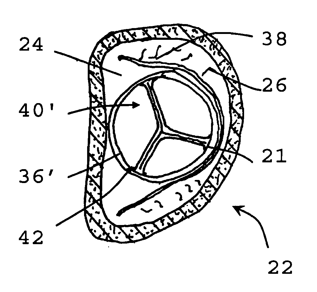 Method for implanting prosthetic valve