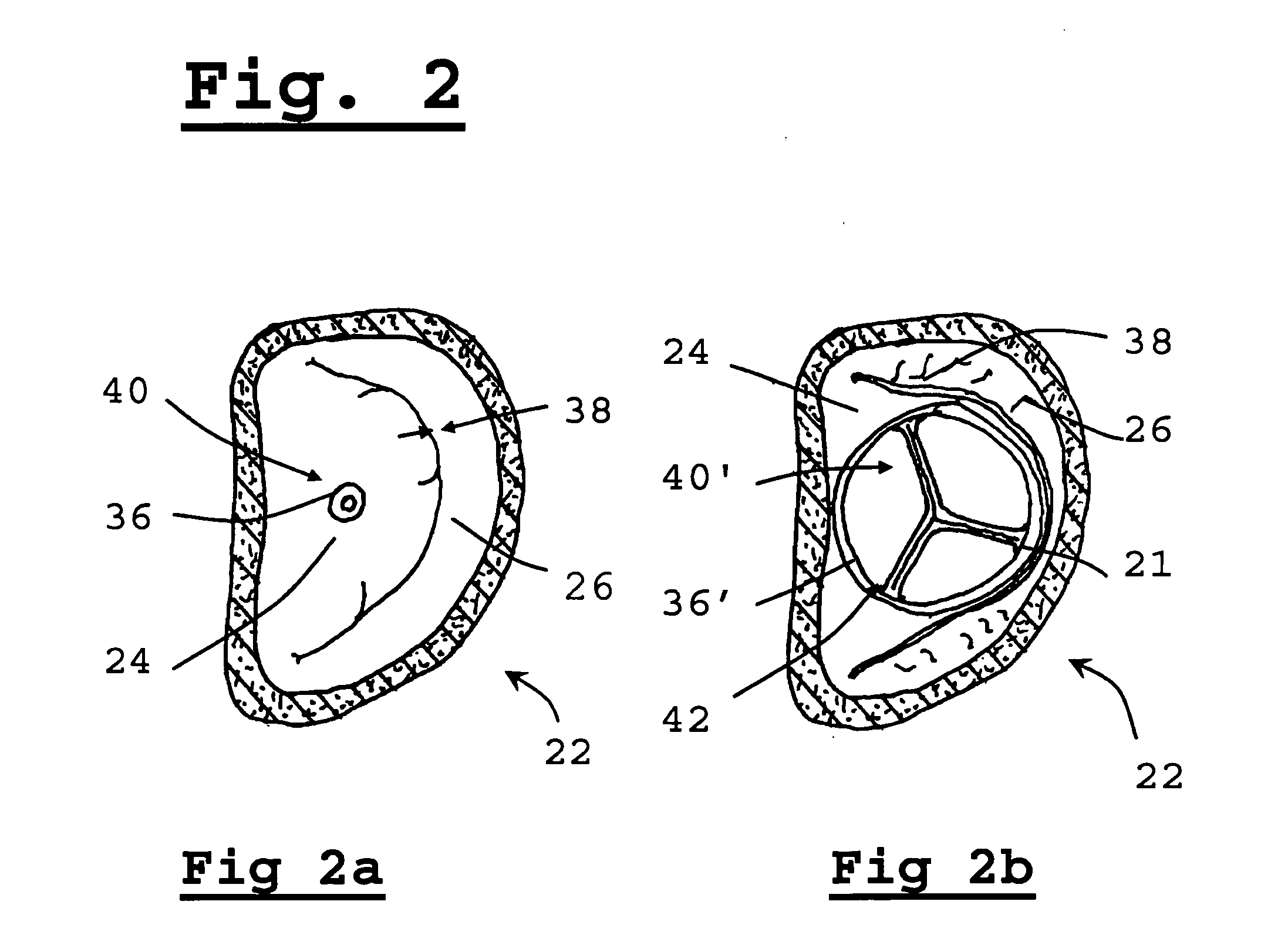 Method for implanting prosthetic valve