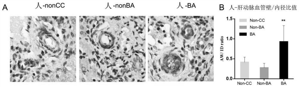 Method based on gene/protein as diagnostic marker and therapeutic target for biliary atresia and application thereof