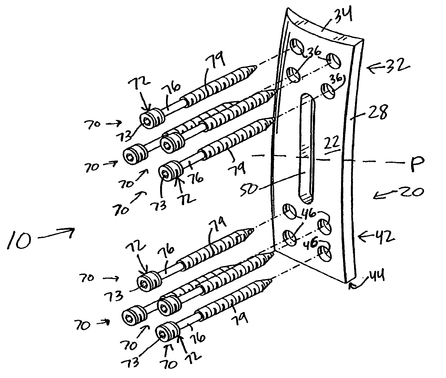 Anterior Adherent Thoracolumbar Spine Plate