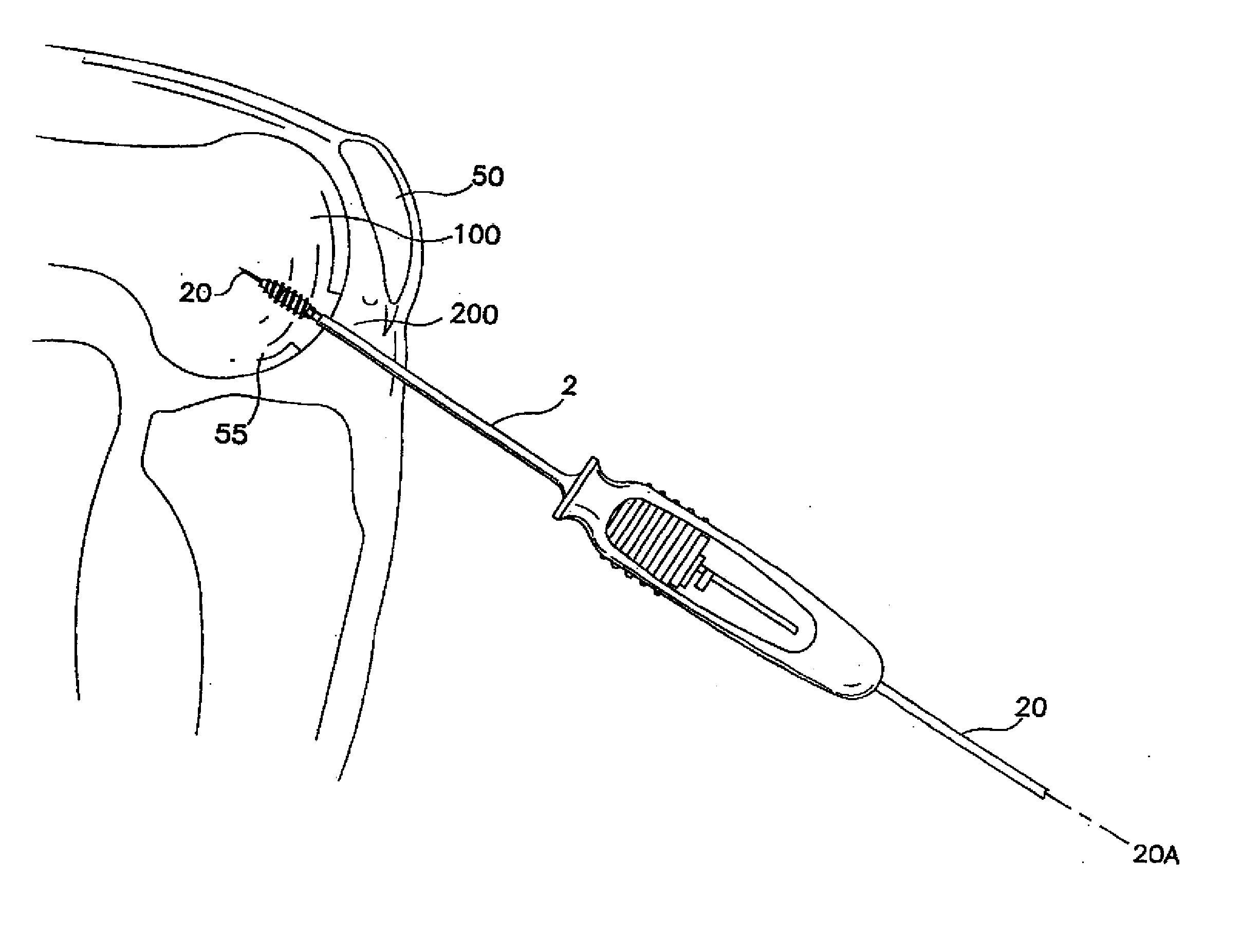 System and method for joint resurface repair