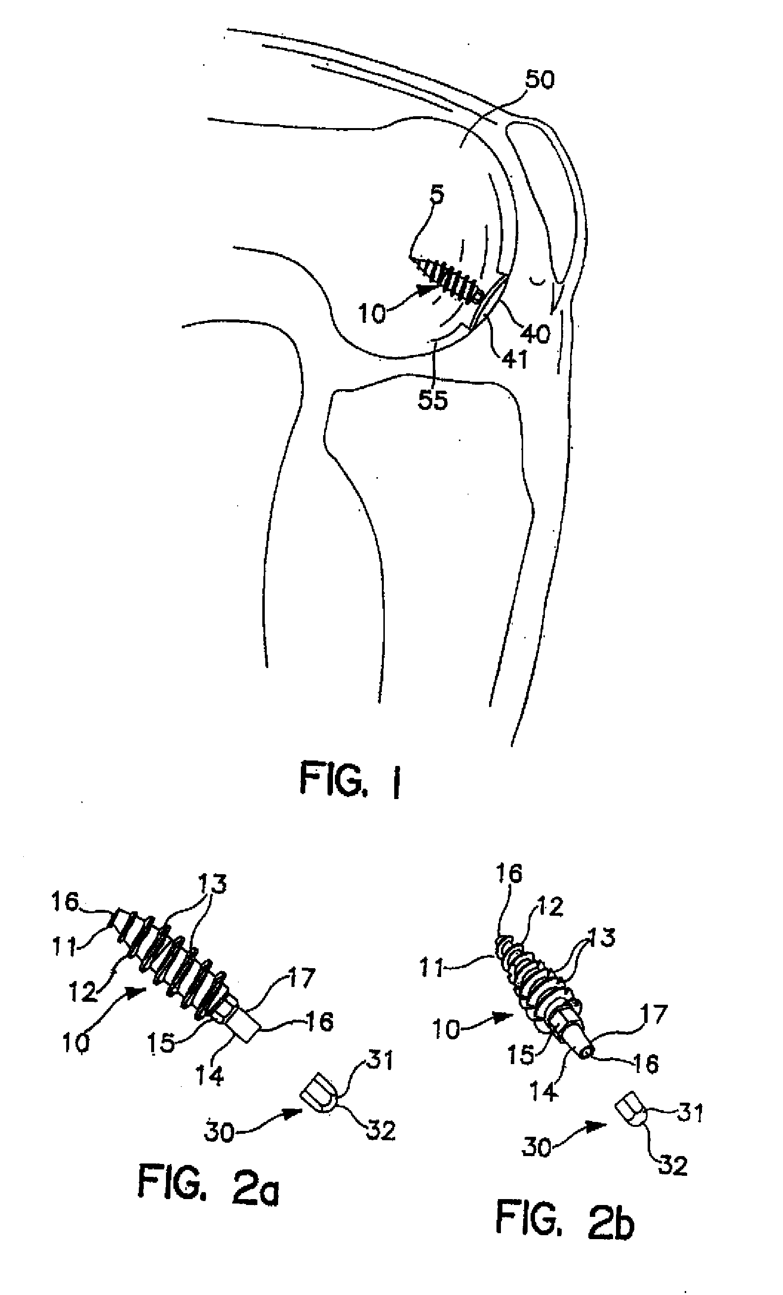 System and method for joint resurface repair