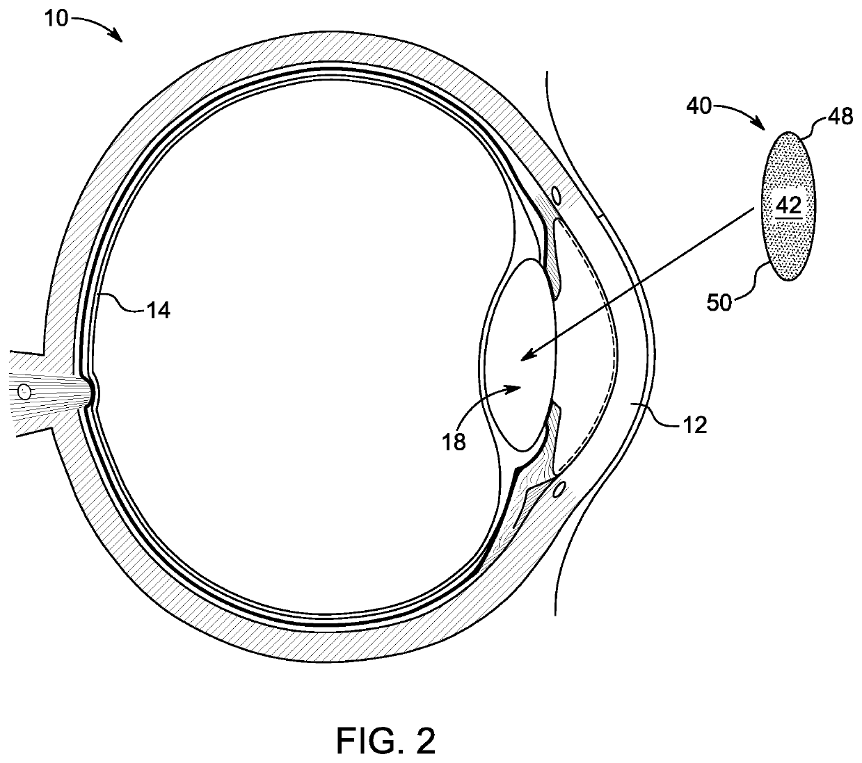 Artificial vision intraocular implant device