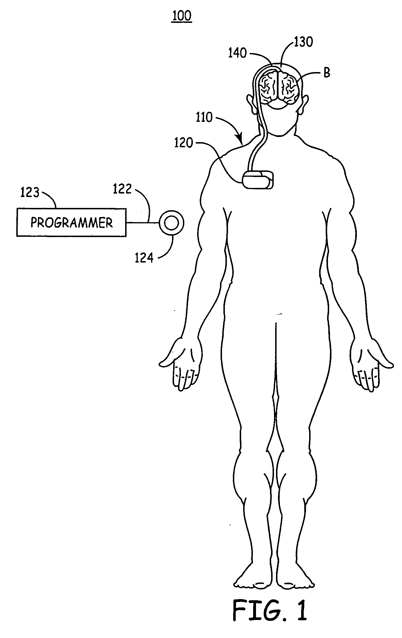 Anchoring of a medical device component adjacent a dura of the brain or spinal cord