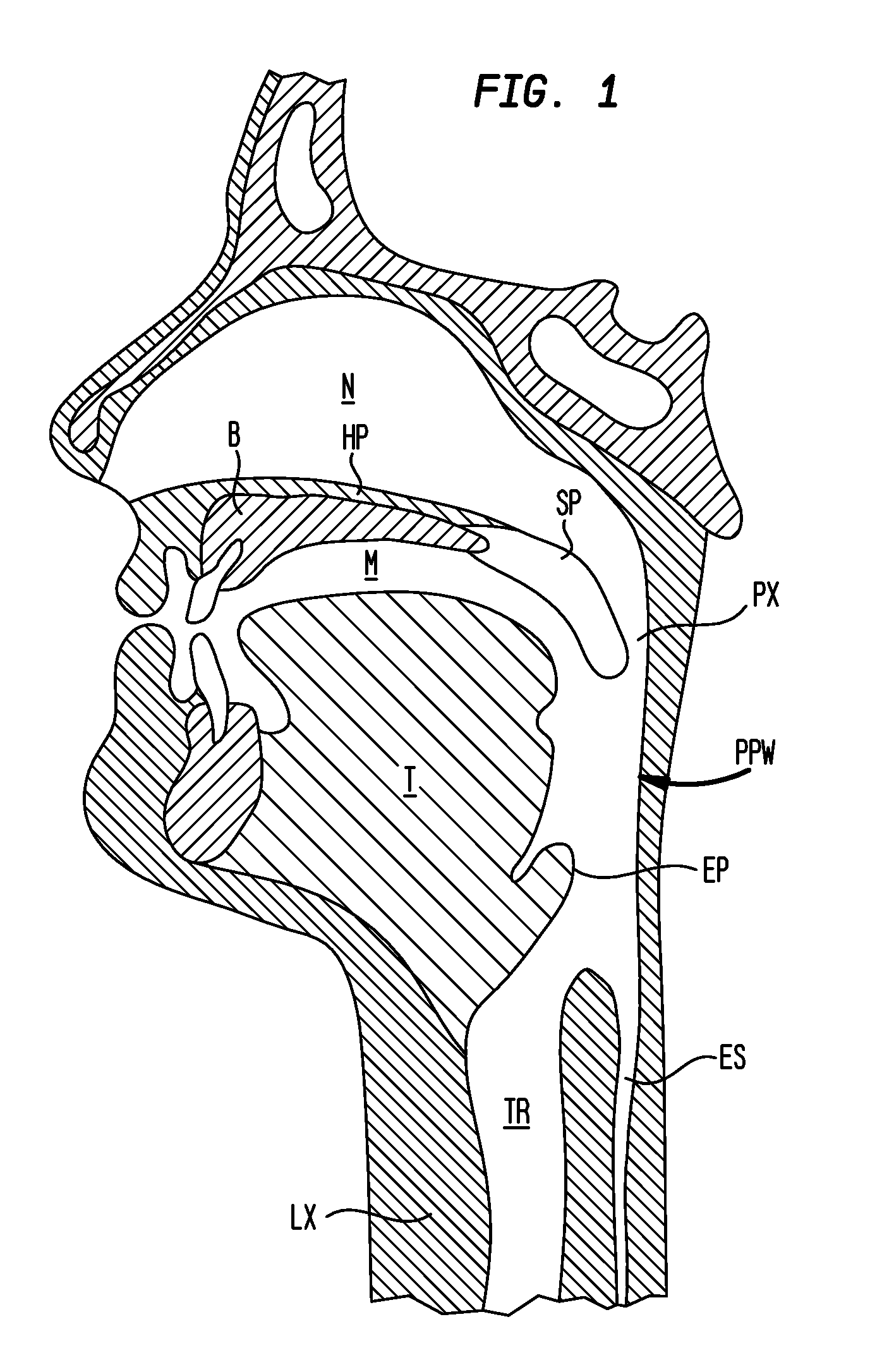 Methods and devices for the indirect displacement of the hyoid bone for treating obstructive sleep apnea