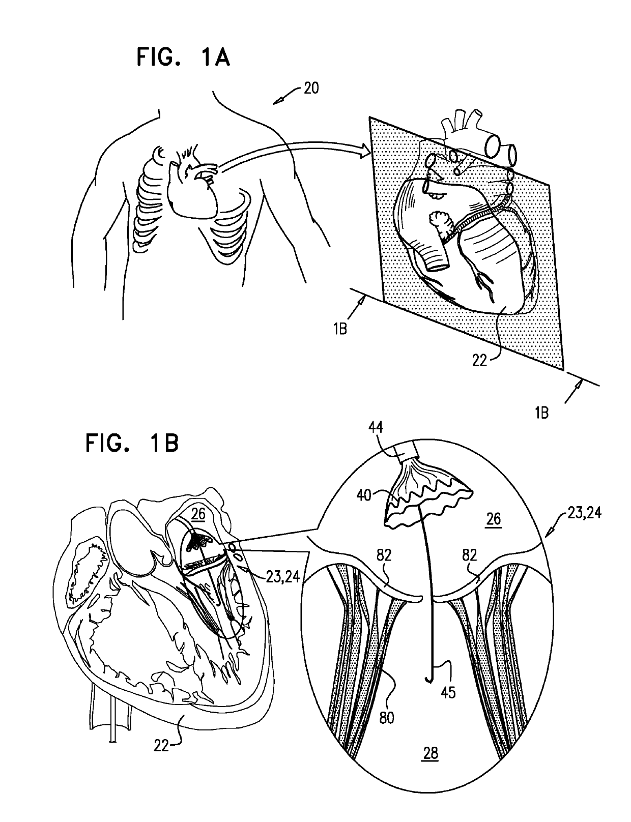 Techniques for percutaneous mitral valve replacement and sealing