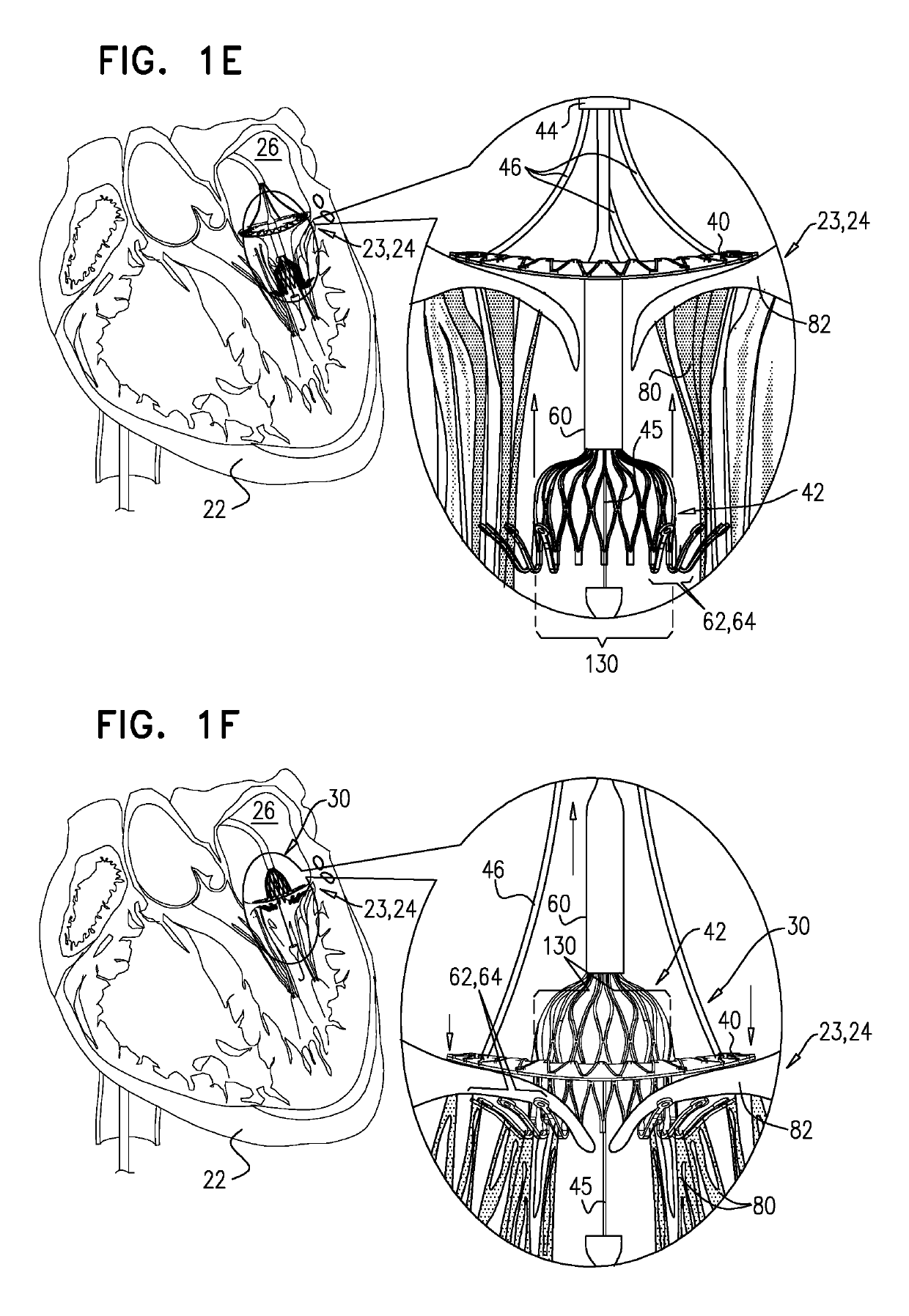 Techniques for percutaneous mitral valve replacement and sealing