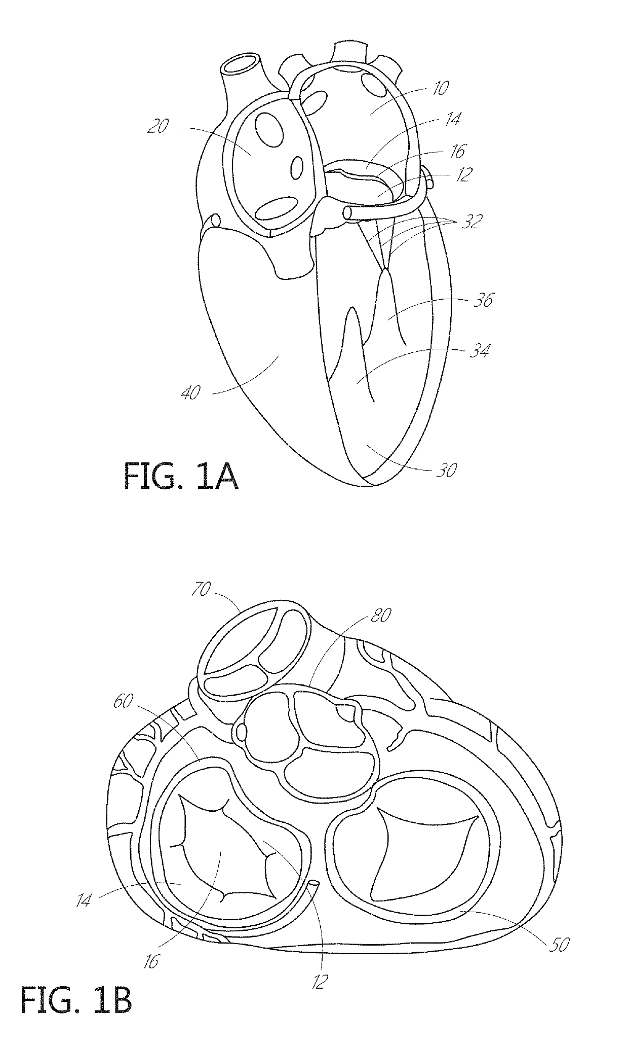 Device, system, and method for transcatheter treatment of valvular regurgitation