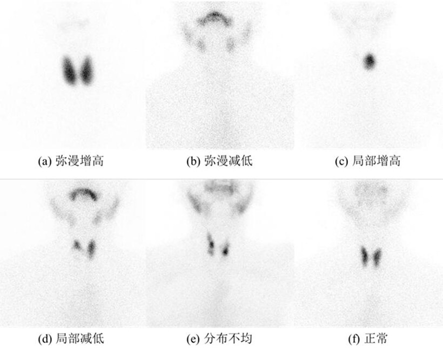 SPECT thyroid imaging intelligent recognition method based on deep neural network