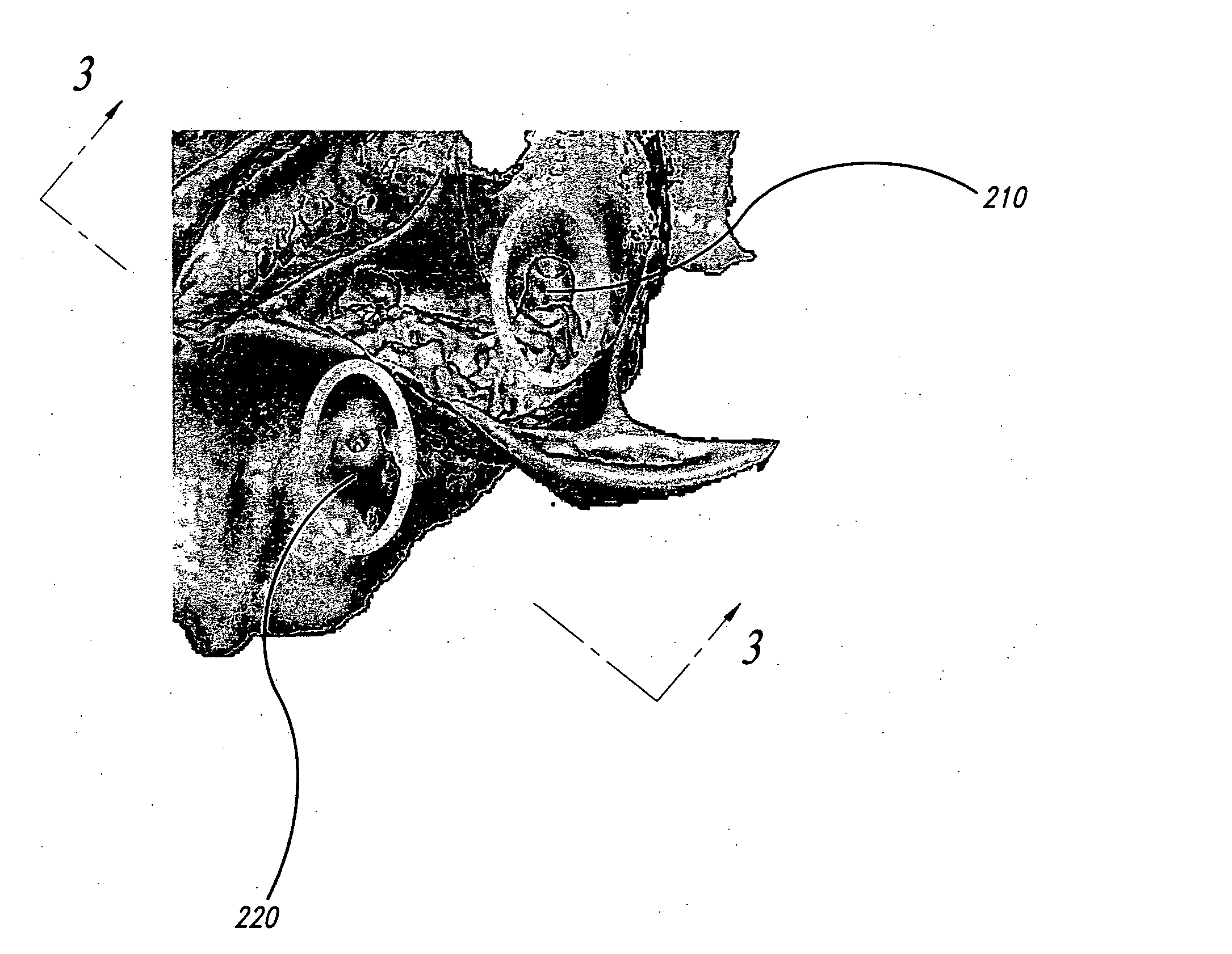 Method of manufacture, installation, and system for a sinus lift bone graft