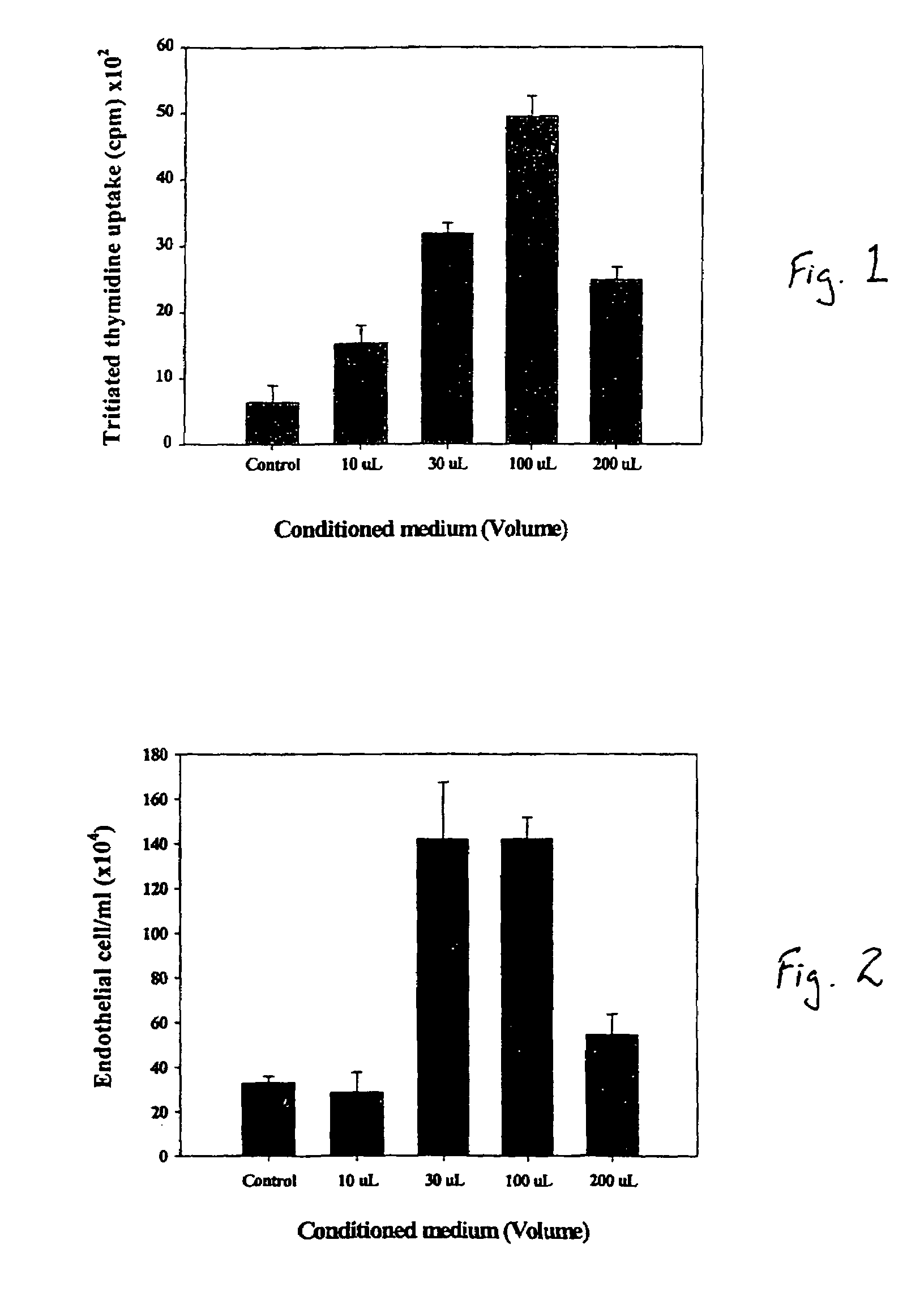 Intramyocardial injection of autologous bone marrow