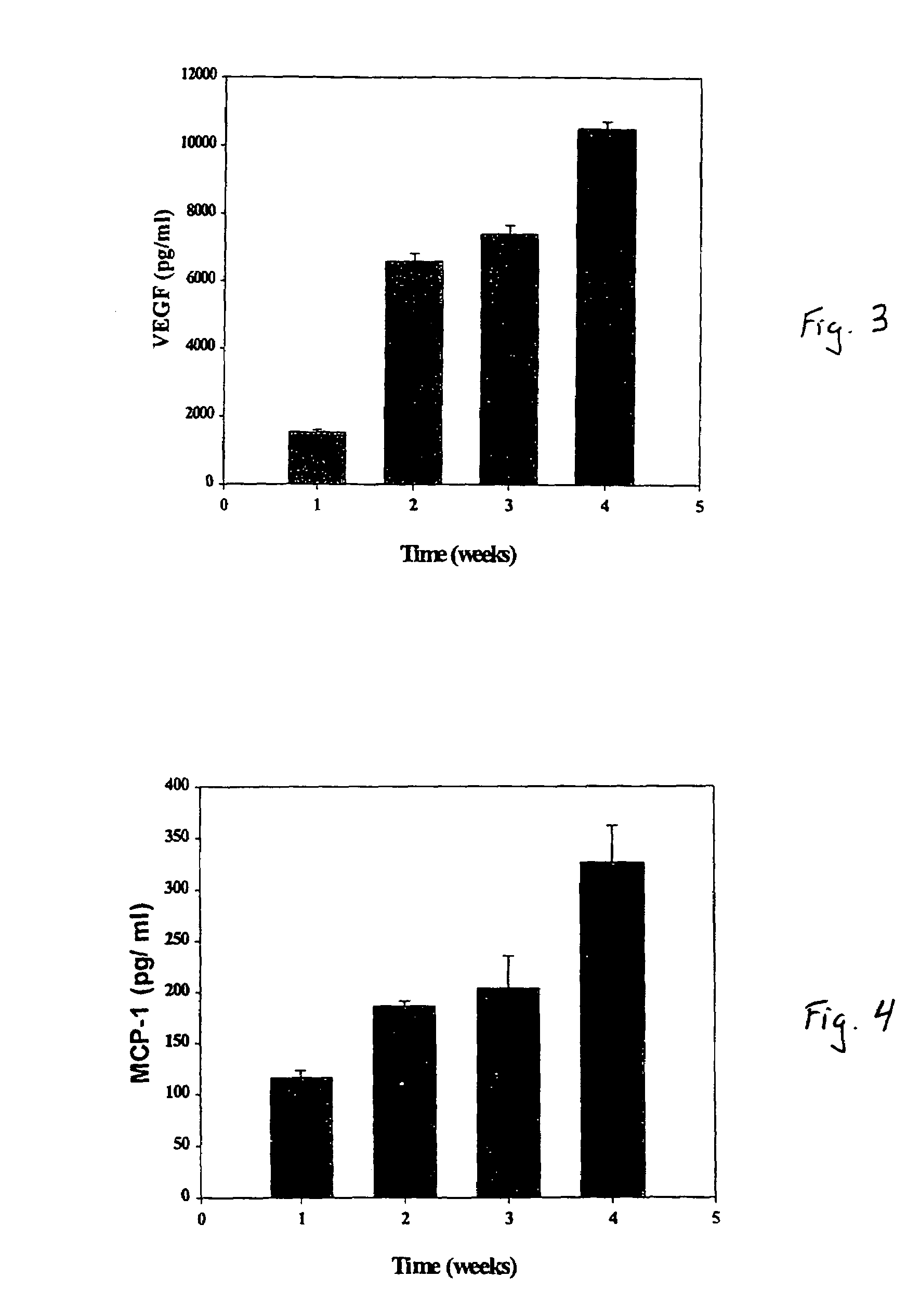 Intramyocardial injection of autologous bone marrow