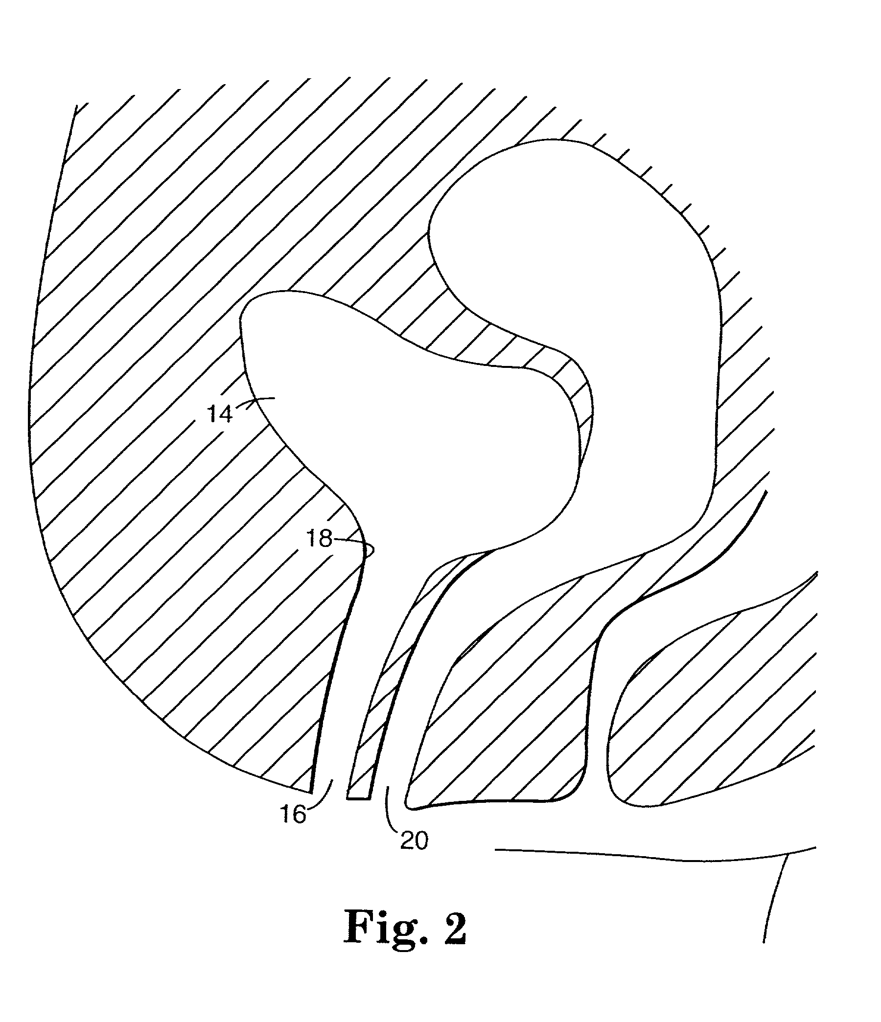 Implantable article and method