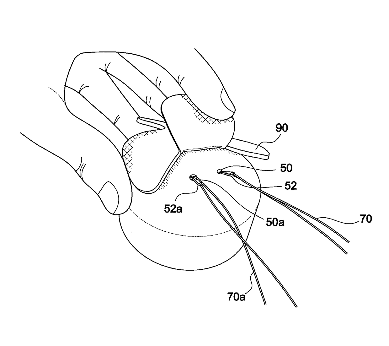 Surgical assembly for rotator cuff repair