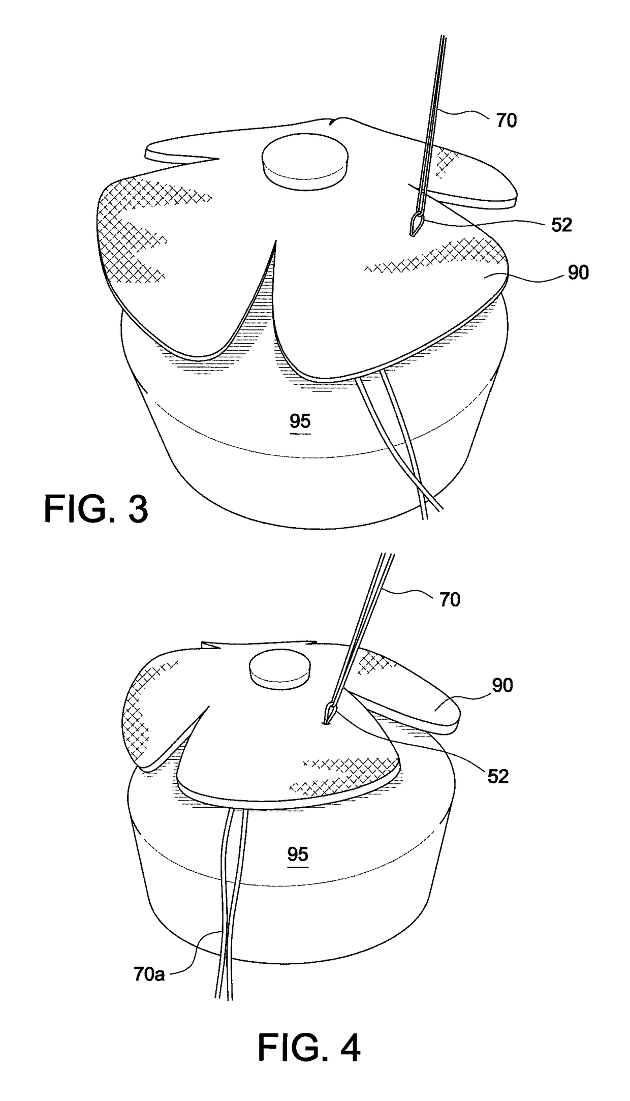 Surgical assembly for rotator cuff repair