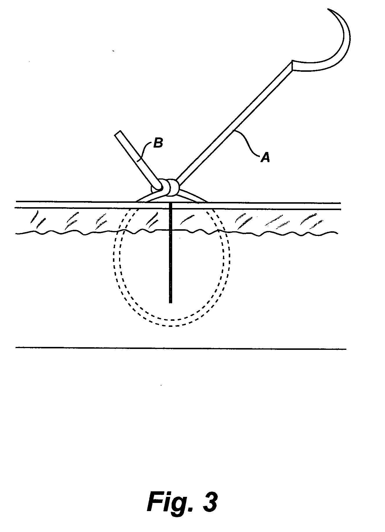 Gliding Stitch for Closing Wounds Under Tension