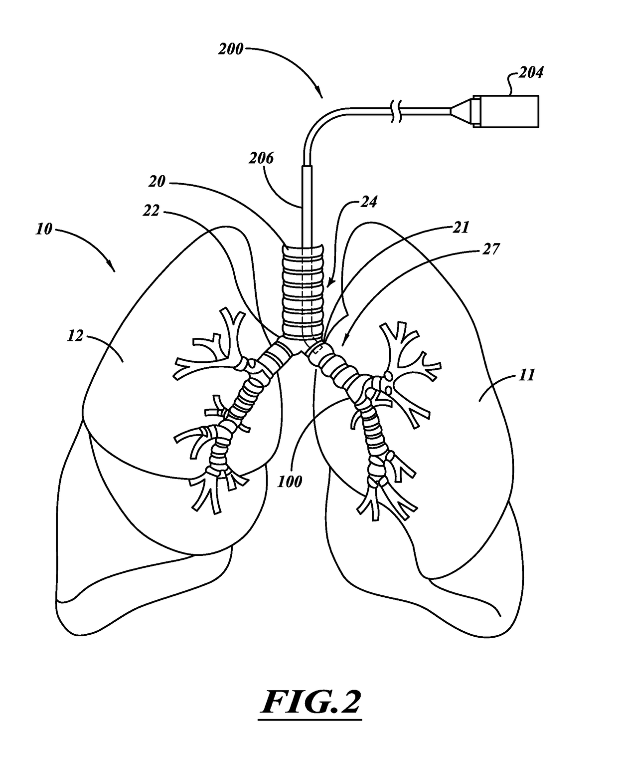 Apparatus for injuring nerve tissue