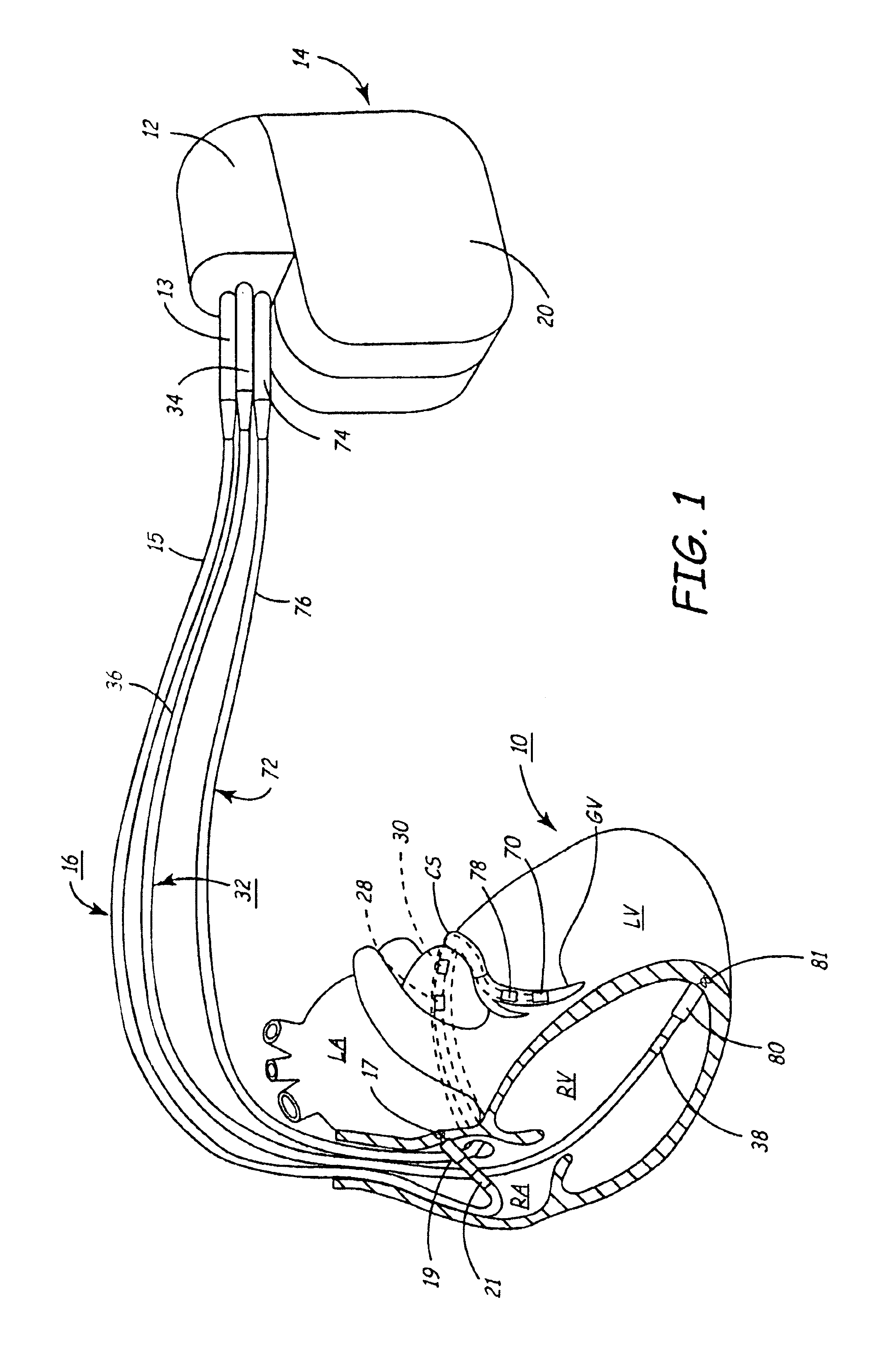 Enhanced method and apparatus to identify and connect a small diameter lead with a low profile lead connector