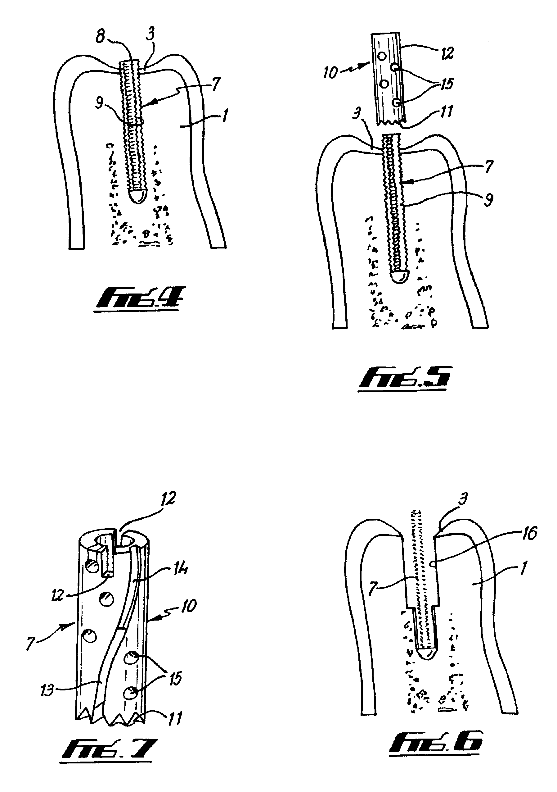 Guide post for trephine