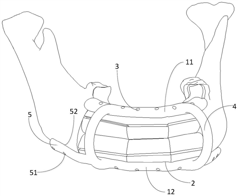 An in-place guide plate applied to multi-segment fibula double stack reconstruction of mandible