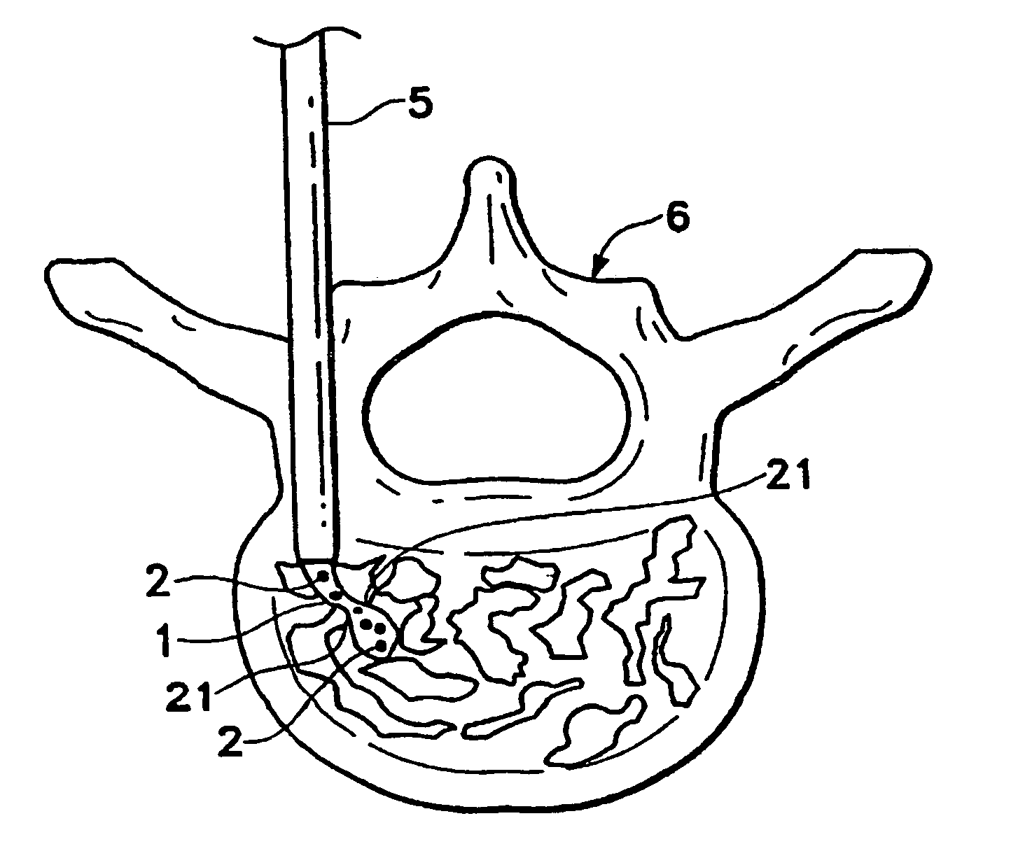 Enhanced visibility materials for implantation in hard tissue