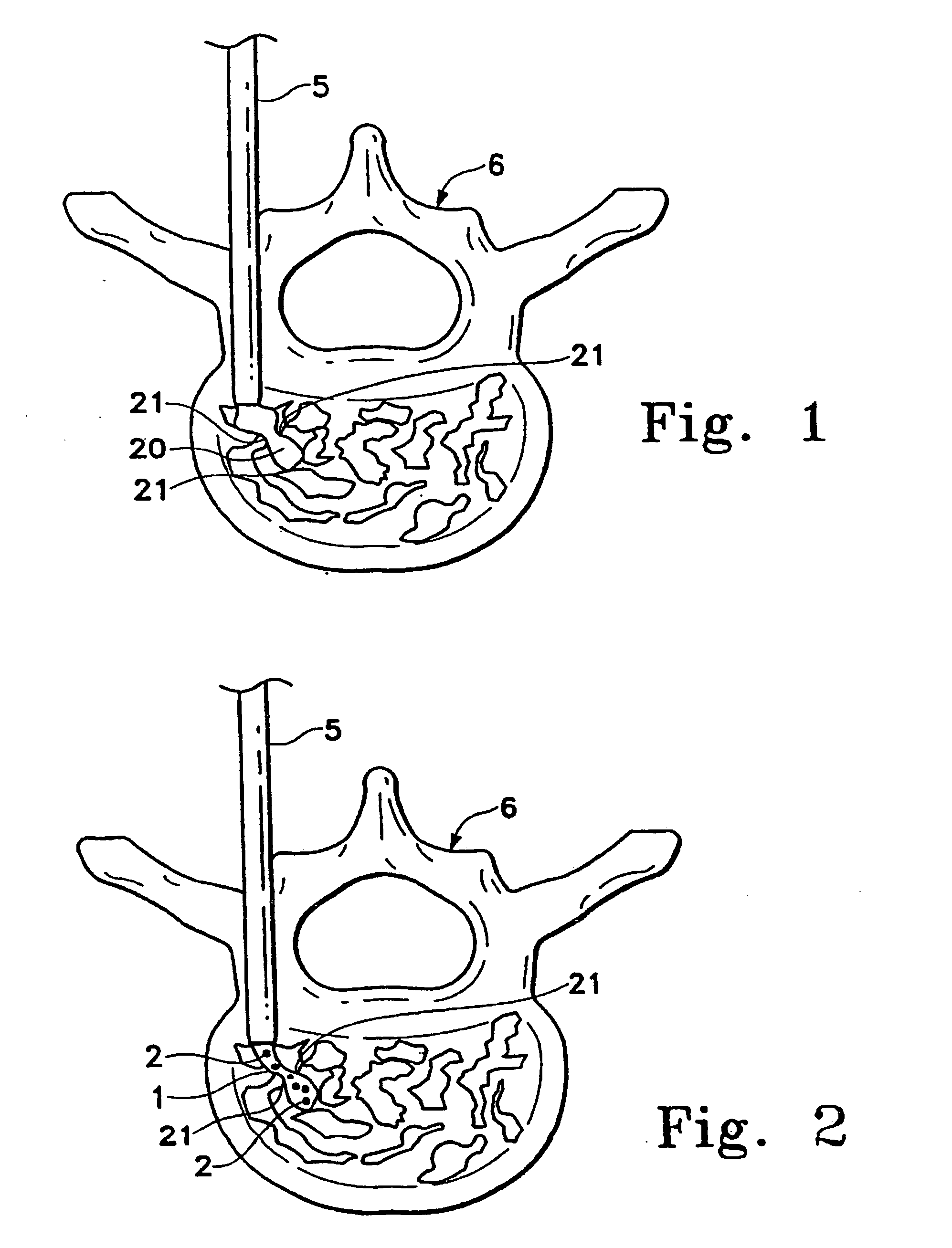 Enhanced visibility materials for implantation in hard tissue