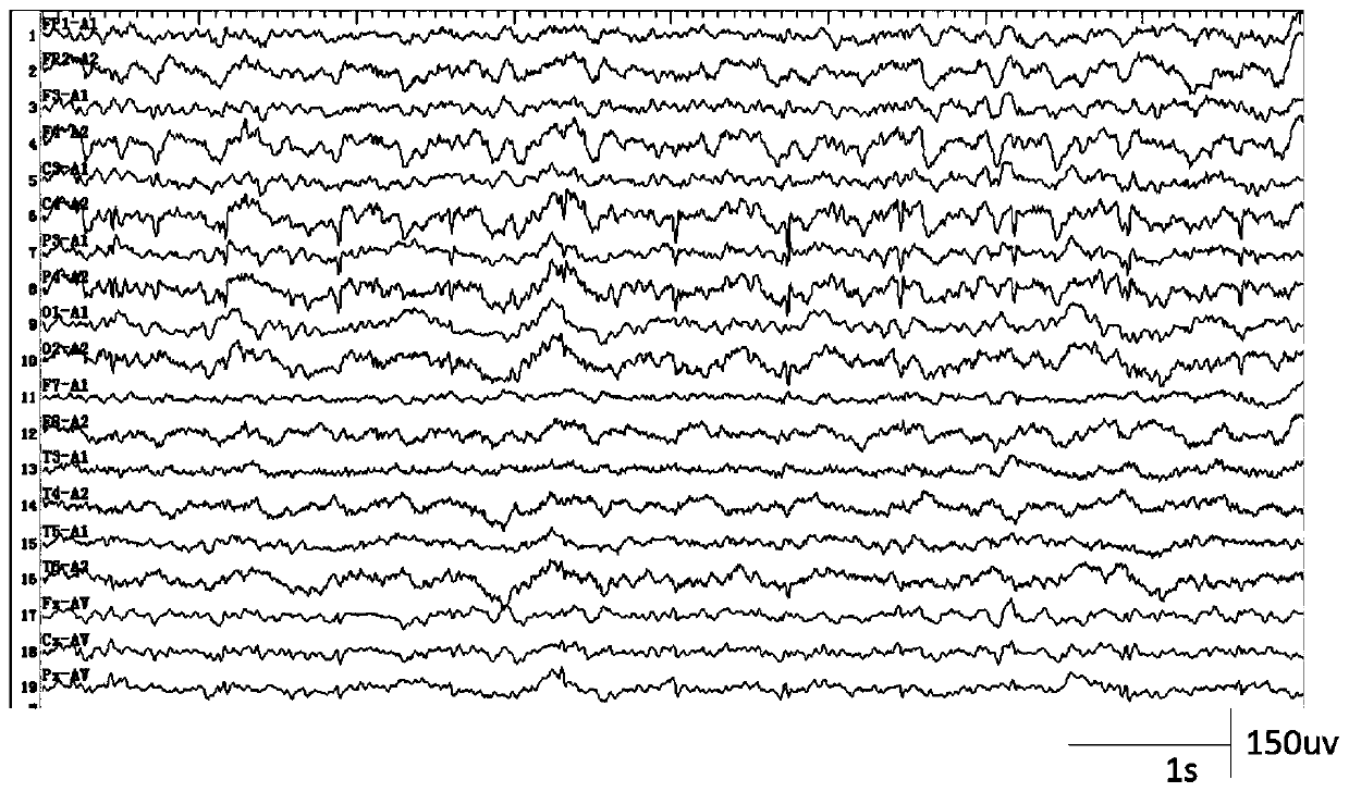 A method for automatic detection of epileptic spikes