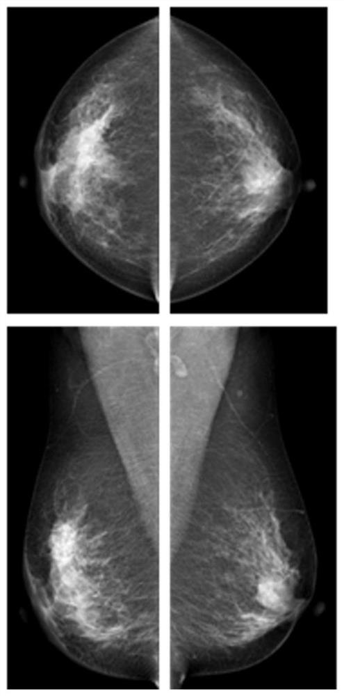 Breast image lesion matching method, device and storage medium