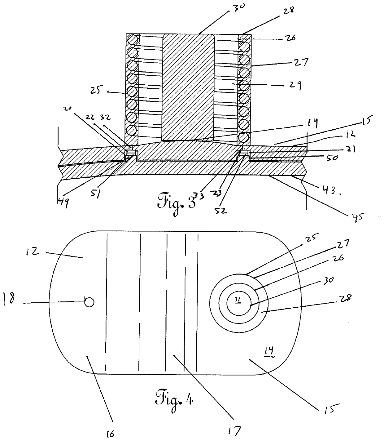 Dental Irrigation Device