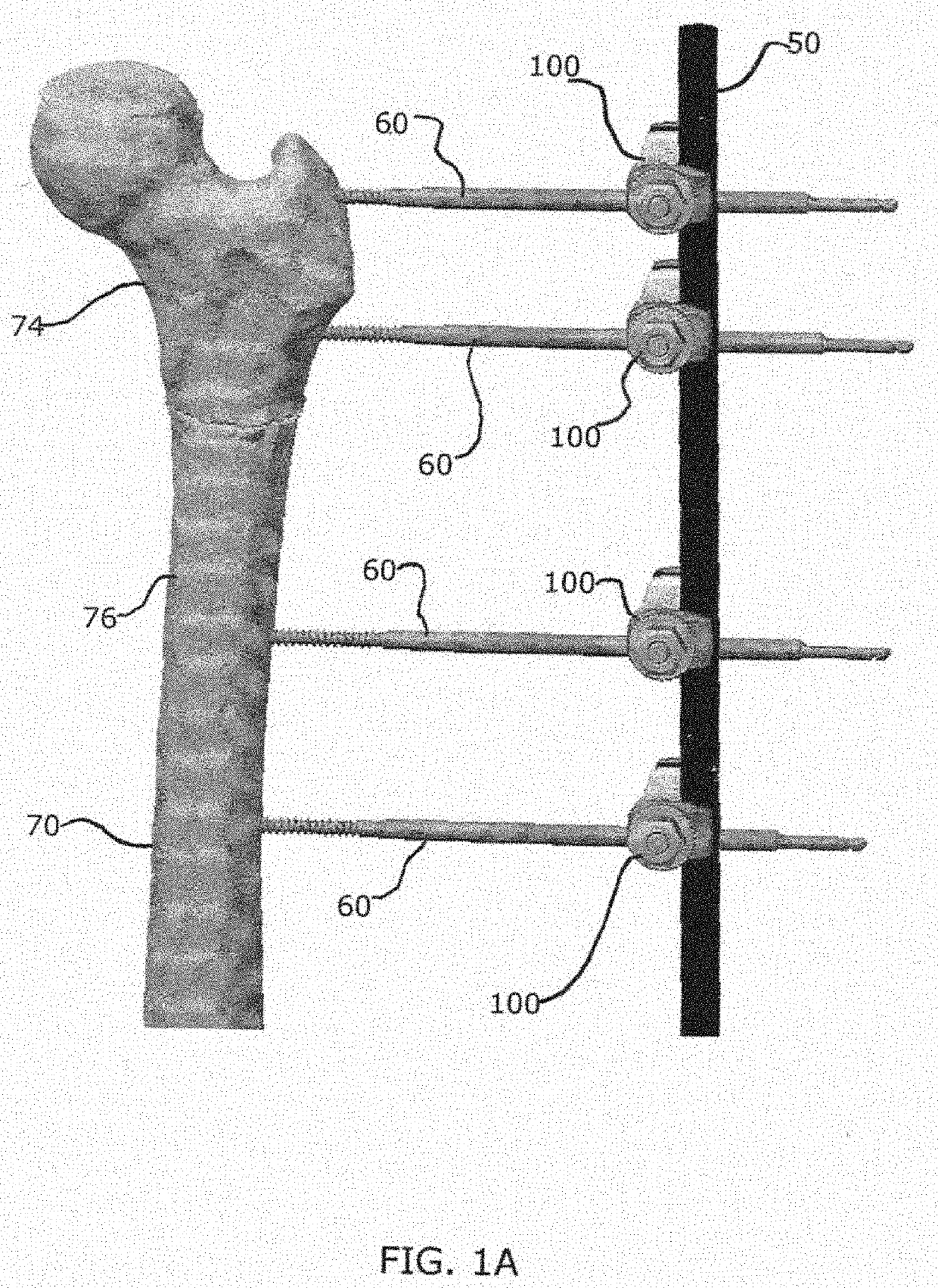 External fixator assembly