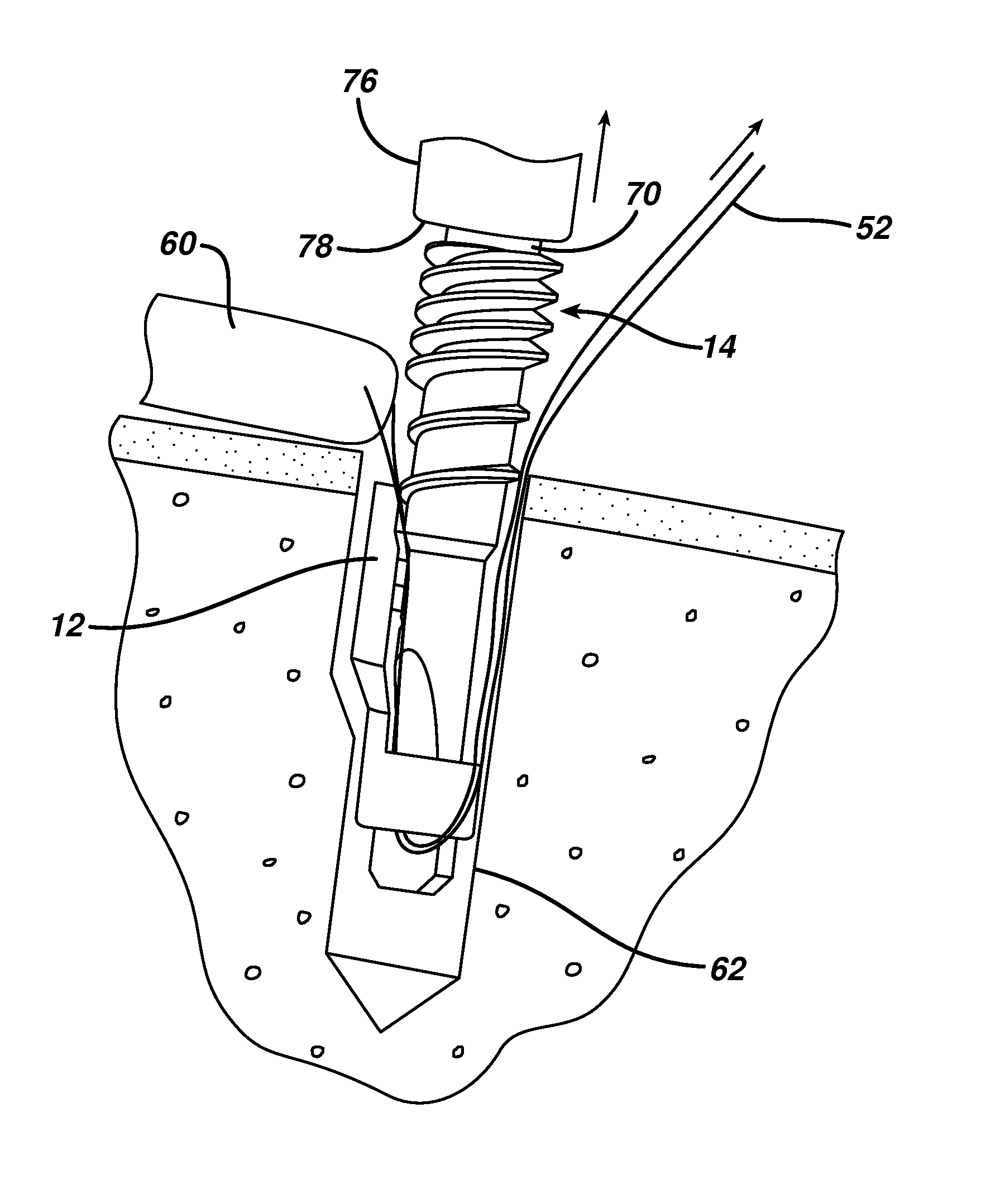 Knotless suture anchor