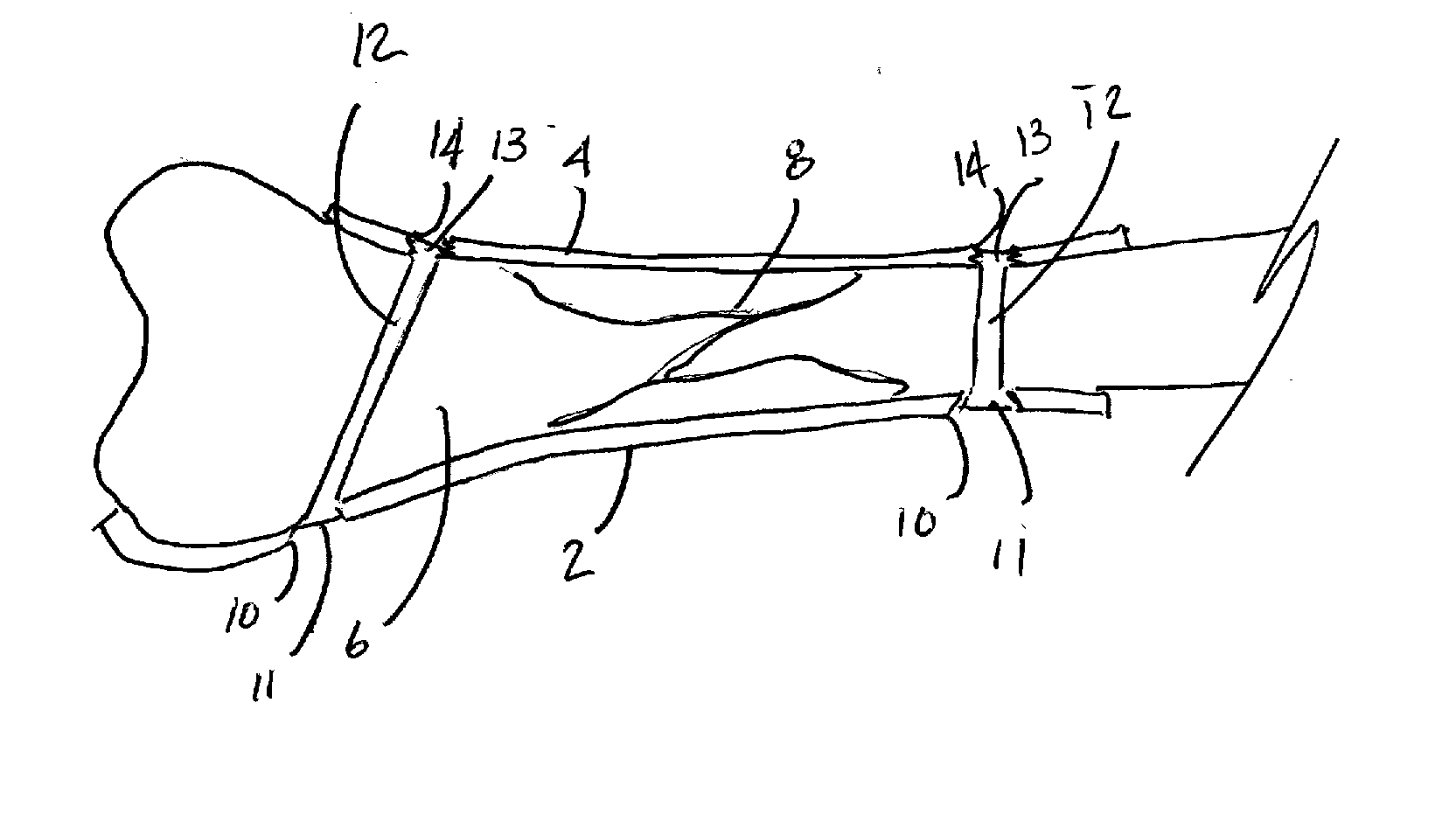 System for making a bone repair