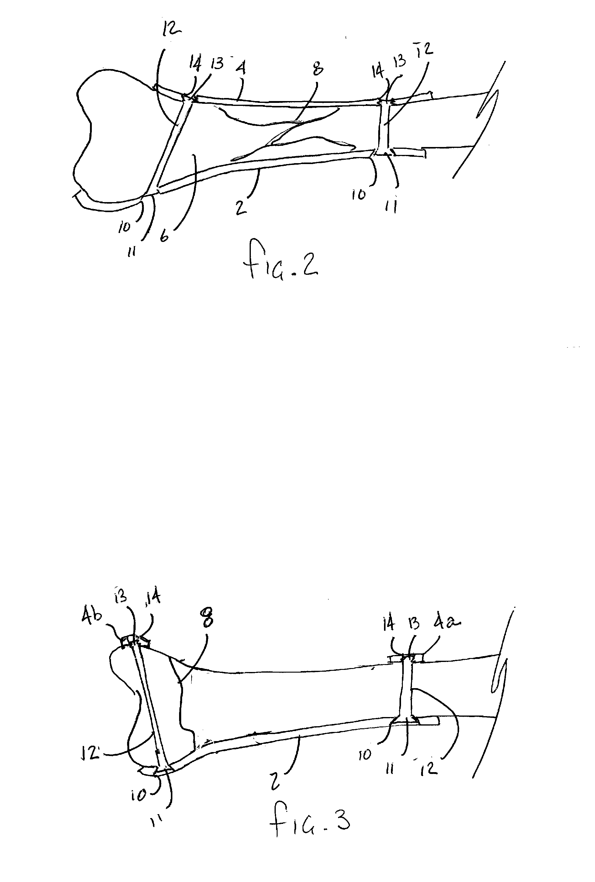 System for making a bone repair