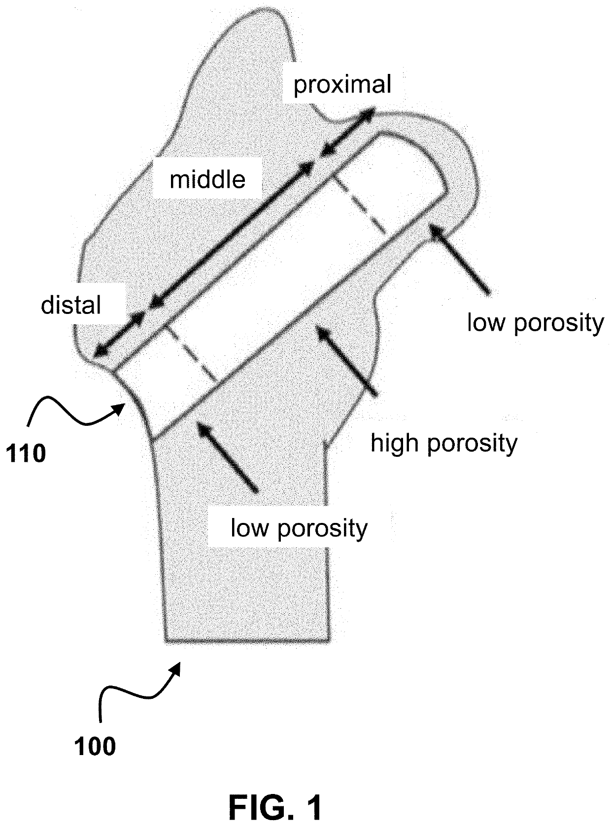 Customized load-bearing and bioactive functionally-graded implant for treatment of osteonecrosis