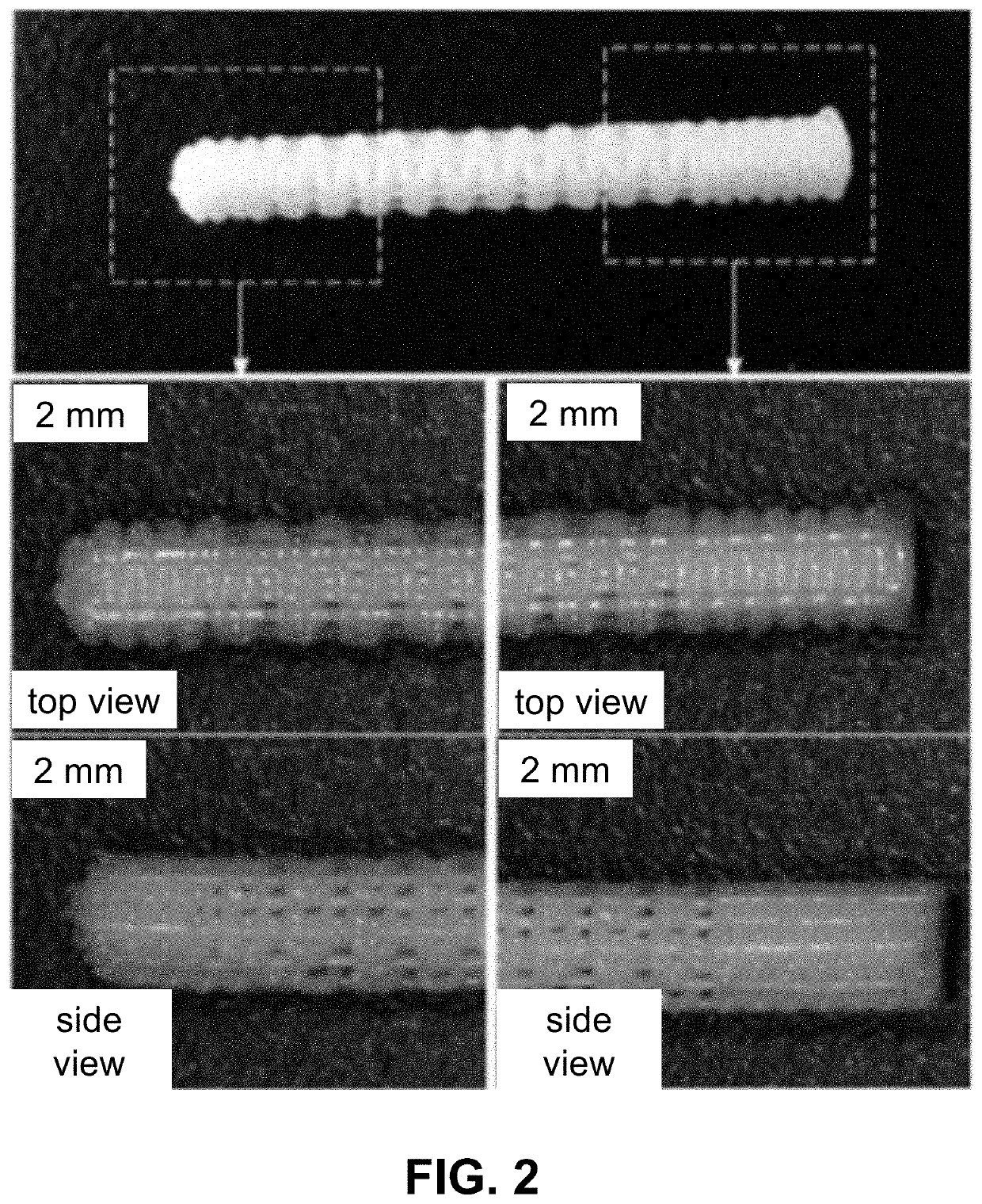 Customized load-bearing and bioactive functionally-graded implant for treatment of osteonecrosis