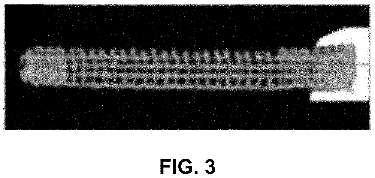 Customized load-bearing and bioactive functionally-graded implant for treatment of osteonecrosis