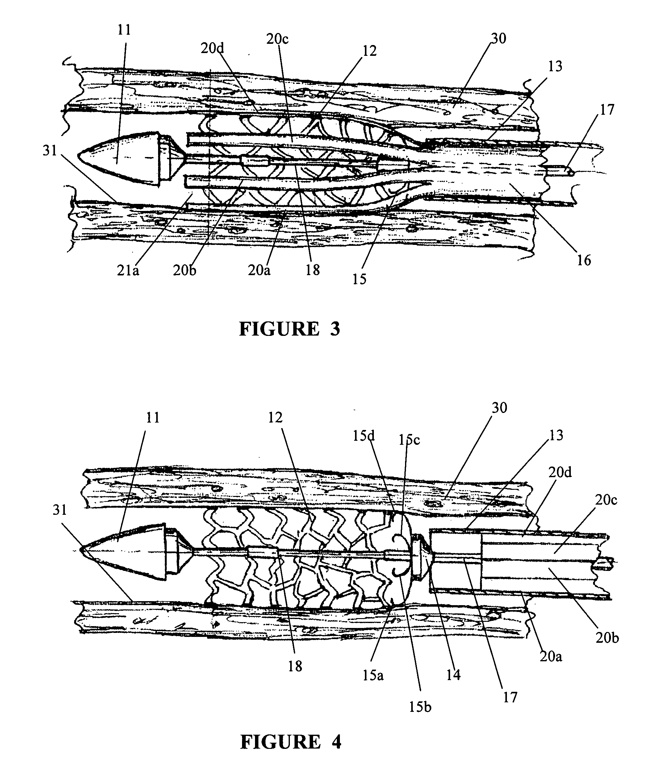 Delivery system for self-expanding stent, a method of using the delivery system, and a method of producing the delivery system