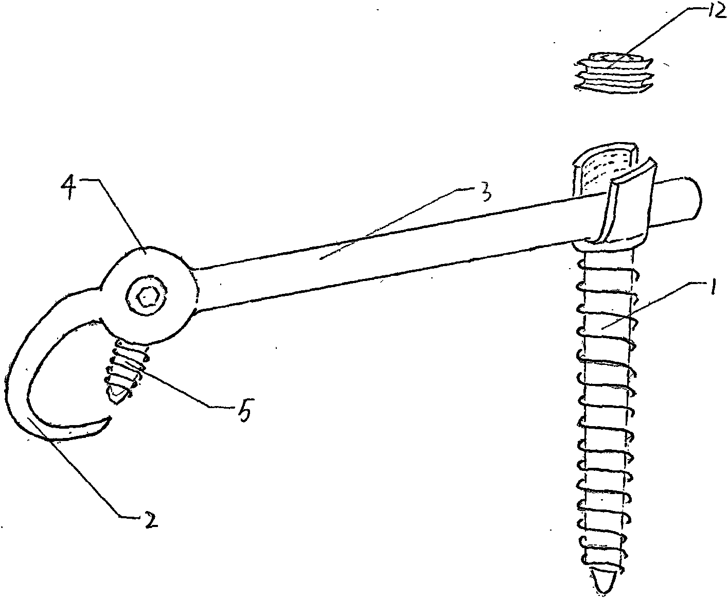 Lumbar spondylolysis restoration internal fixation system