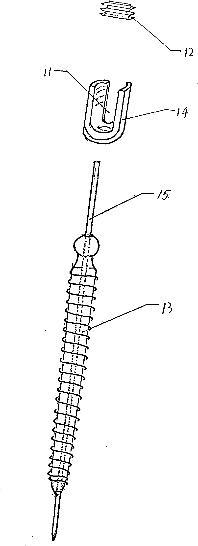 Lumbar spondylolysis restoration internal fixation system