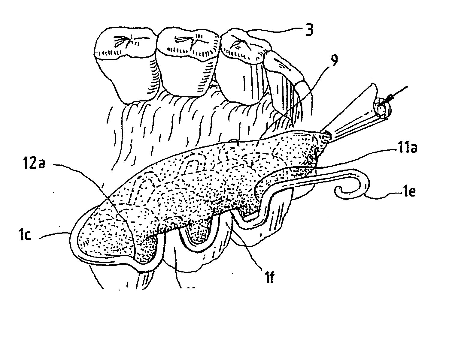 Dental impression method and device